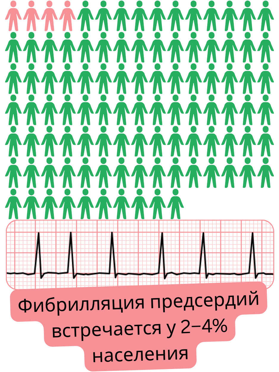 Инфографика, показывающая распространённость фибрилляции предсердий в общей популяции на уровне около 2–4%.