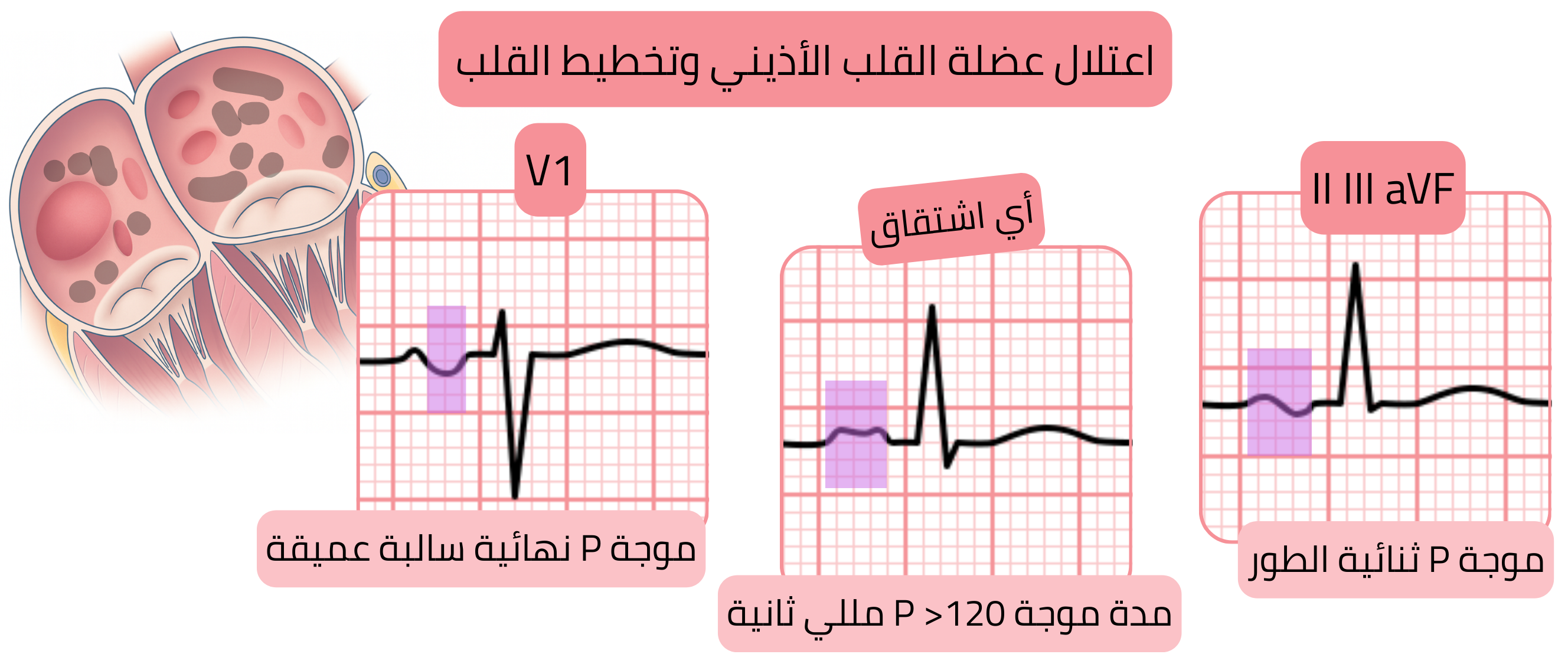 مخطط لاعتلال عضلة القلب الأذيني يوضح خصائص تخطيط القلب بما في ذلك موجة P نهائية سالبة عميقة في V1، واتساع موجة P لأكثر من 120 مللي ثانية، وموجات P ثنائية الطور في الاشتقاقات II وIII وaVF.