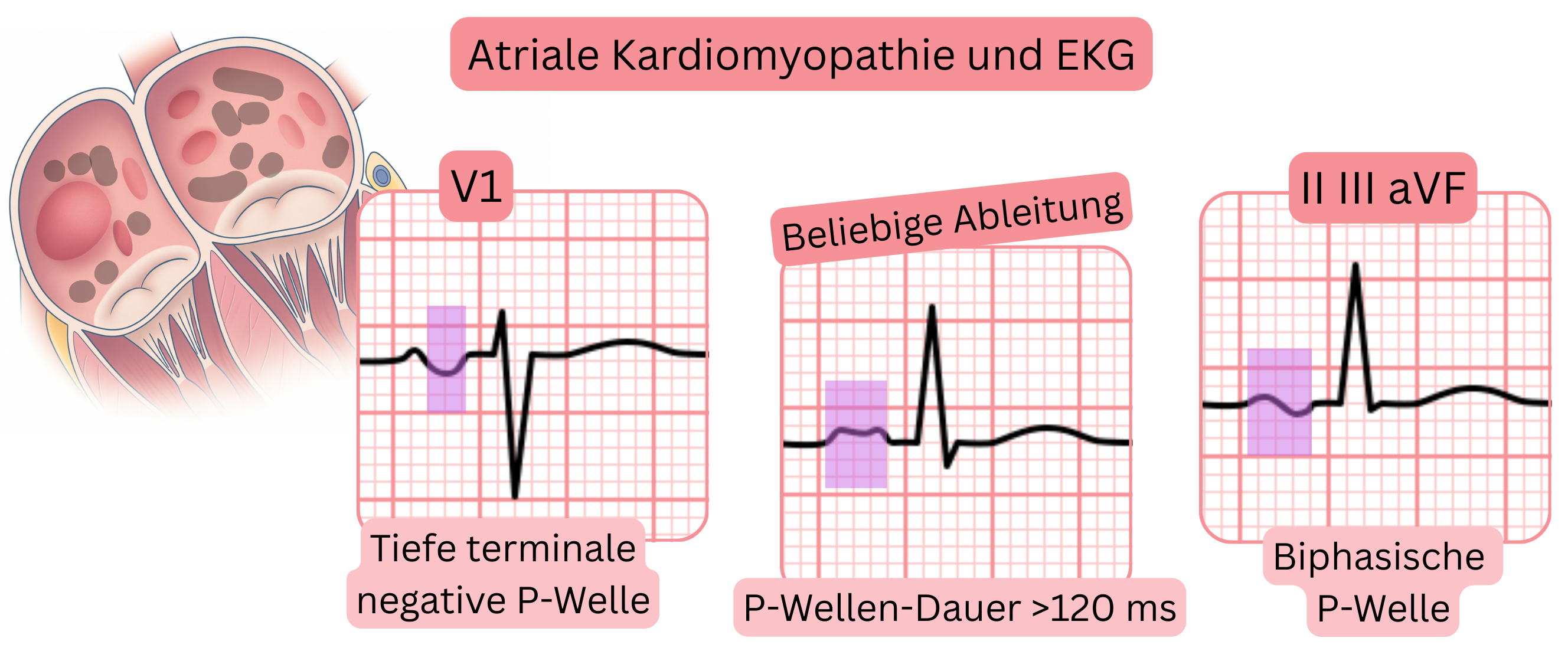 Schema der atrialen Kardiomyopathie mit Darstellung typischer EKG-Merkmale, einschließlich tiefer terminal negativer P-Welle in V1, verlängerter P-Wellen-Dauer über 120 ms und biphasischer P-Wellen in den Ableitungen II, III und aVF.