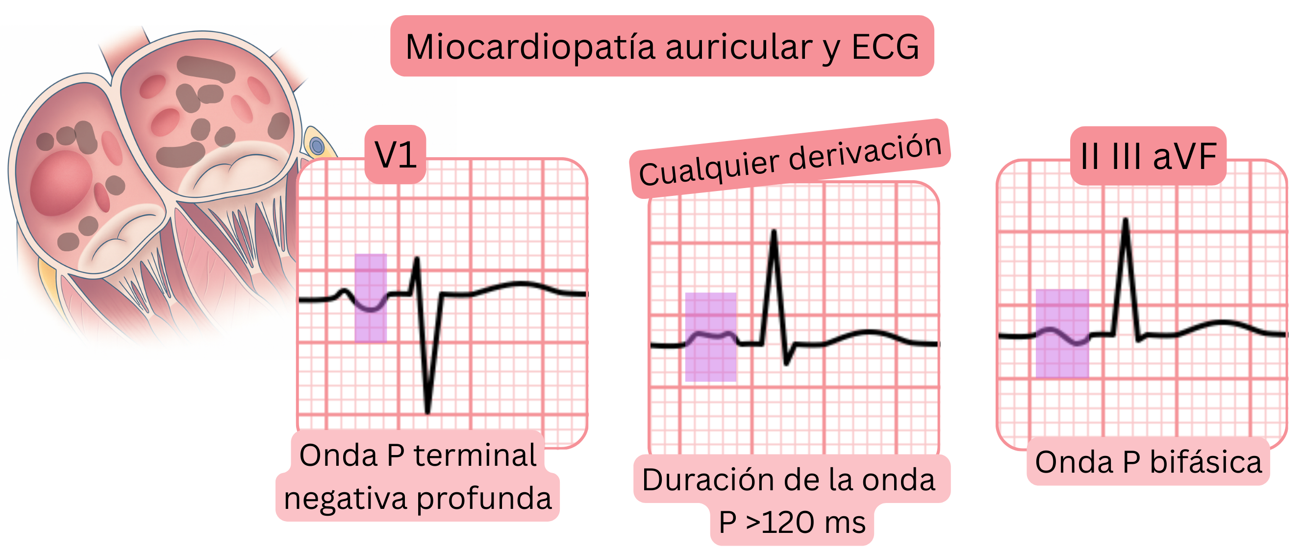 Esquema de la miocardiopatía auricular que muestra hallazgos en el ECG, incluyendo una onda P terminal negativa profunda en V1, duración de la onda P superior a 120 ms y ondas P bifásicas en las derivaciones II, III y aVF.