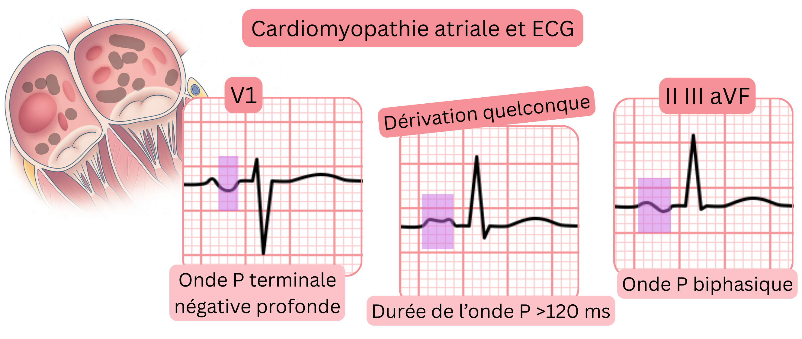 Schéma de la cardiomyopathie atriale illustrant les signes ECG, incluant une onde P terminale négative profonde en V1, un élargissement de l’onde P supérieur à 120 ms et des ondes P biphasées dans les dérivations II, III et aVF.