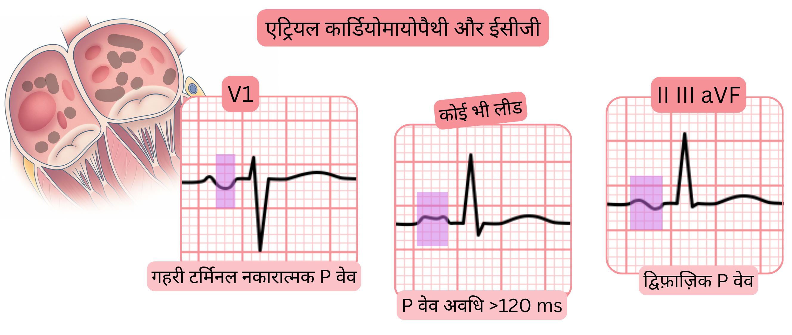 एट्रियल कार्डियोमायोपैथी का आरेख जो ईसीजी विशेषताएँ दर्शाता है, जिनमें V1 में गहरी टर्मिनल नकारात्मक P वेव, 120 मिलीसेकंड से अधिक विस्तारित P वेव और II, III तथा aVF लीड्स में द्वि-चरणीय P वेव शामिल हैं।