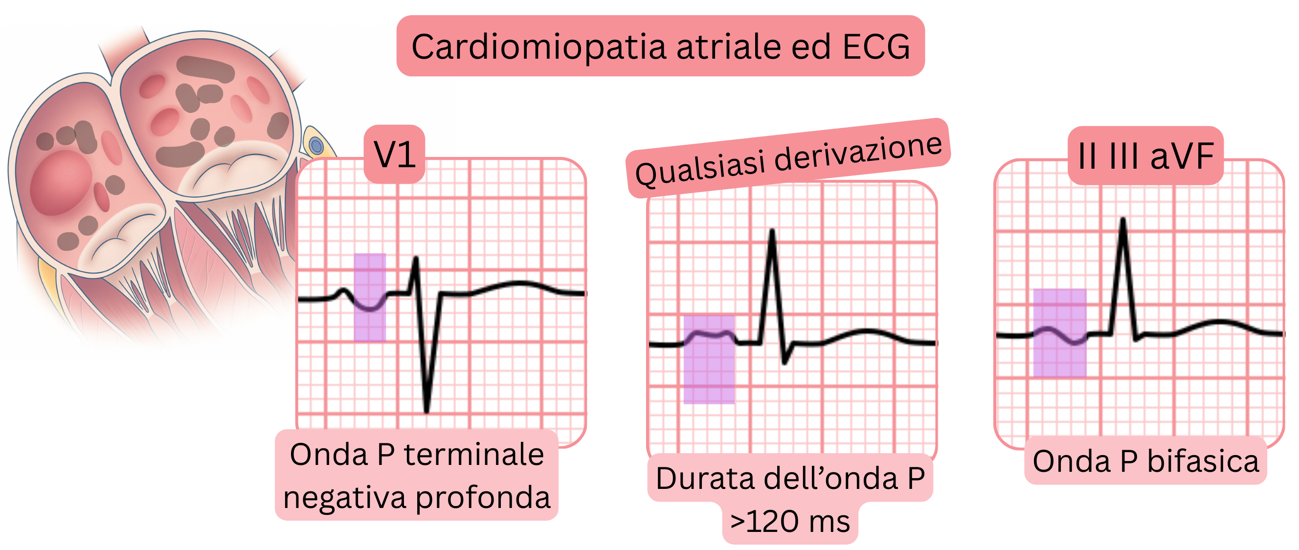 Schema della cardiomiopatia atriale che illustra i reperti ECG, inclusi un’onda P terminale negativa profonda in V1, una durata dell’onda P superiore a 120 ms e onde P bifasiche nelle derivazioni II, III e aVF.