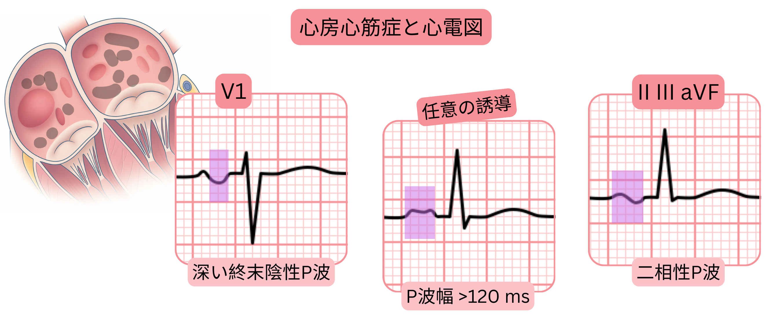 心房心筋症の模式図で、V1誘導における深い終末陰性P波、120ミリ秒を超えるP波延長、ならびにII、III、aVF誘導での二相性P波などの心電図所見を示す。