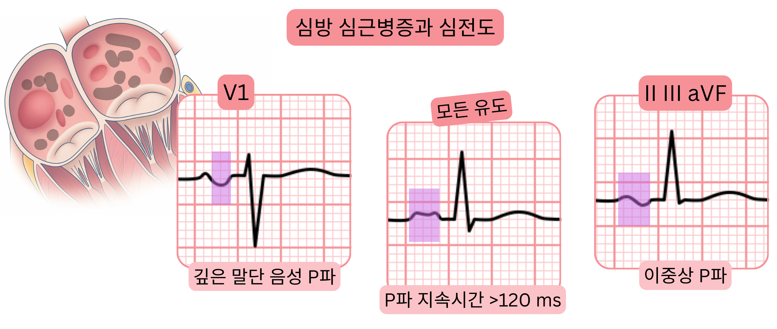 심방 심근병증을 나타내는 도식으로, V1에서의 깊은 말단 음성 P파, 120ms를 초과한 P파 연장, 그리고 II, III, aVF 유도에서의 이단성 P파 등 심전도 소견을 보여준다.