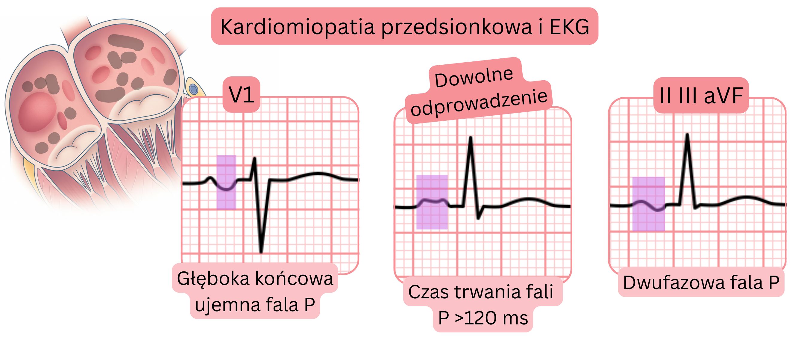 Schemat kardiomiopatii przedsionkowej przedstawiający cechy EKG, w tym głęboką końcową ujemną falę P w V1, poszerzenie fali P powyżej 120 ms oraz dwufazowe fale P w odprowadzeniach II, III i aVF.
