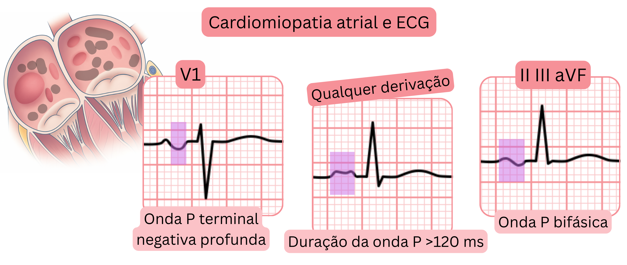 Esquema de cardiomiopatia atrial mostrando achados no ECG, incluindo onda P terminal negativa profunda em V1, duração da onda P superior a 120 ms e ondas P bifásicas nas derivações II, III e aVF.