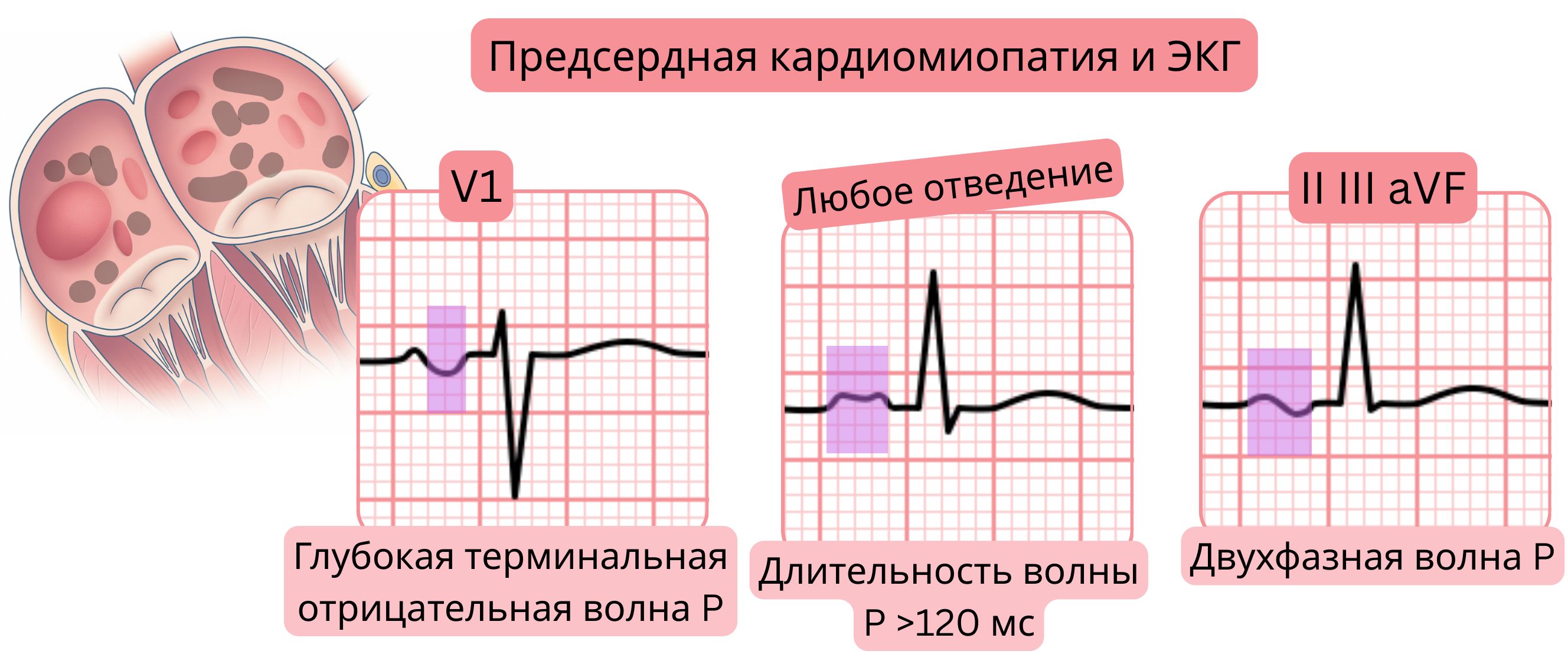 Схема предсердной кардиомиопатии с отображением ЭКГ-признаков, включая глубокую терминальную отрицательную волну P в V1, расширение волны P более 120 мс и бифазные волны P в отведениях II, III и aVF.