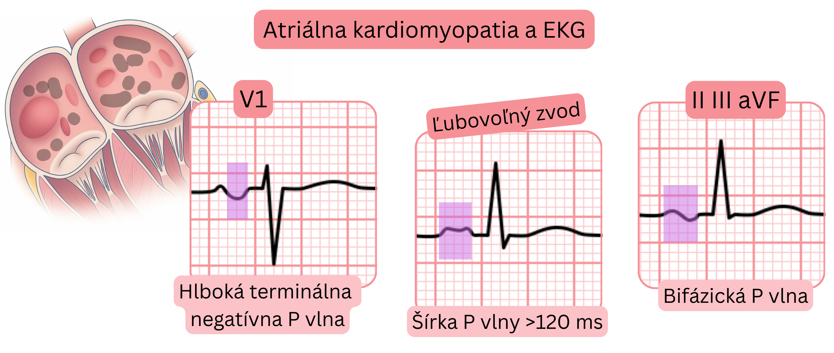 Schéma atriálnej kardiomyopatie zobrazujúca EKG znaky vrátane hlbokej terminálnej negatívnej P vlny vo V1, rozšírenej P vlny nad 120 ms a bifázickej P vlny v zvodoch II, III a aVF.