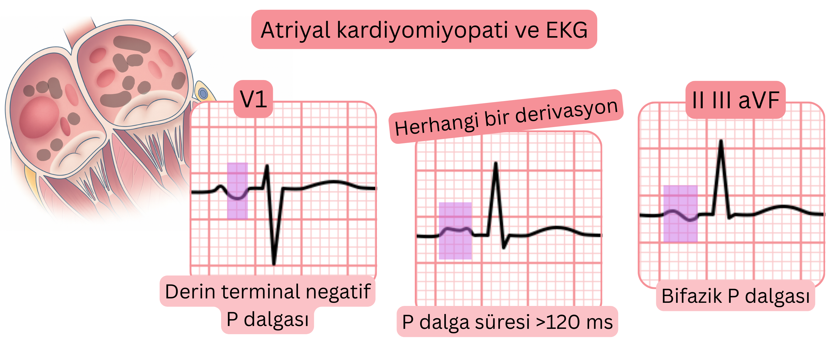 Atriyal kardiyomiyopatiyi gösteren şema; V1’de derin terminal negatif P dalgası, 120 ms’nin üzerinde uzamış P dalga süresi ve II, III ile aVF derivasyonlarında bifazik P dalgaları gibi EKG bulgularını içerir.