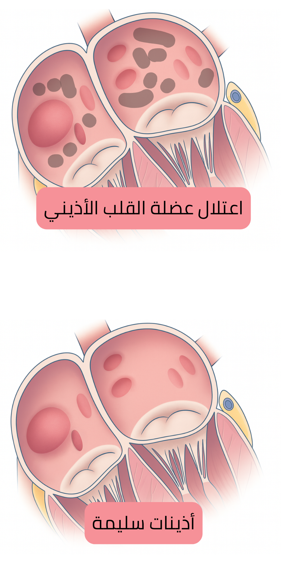 رسم توضيحي يقارن اعتلال عضلة القلب الأذيني بالأذينين السليمين، موضحًا التغيرات البنيوية والنسيجية المرتبطة بالرجفان الأذيني.