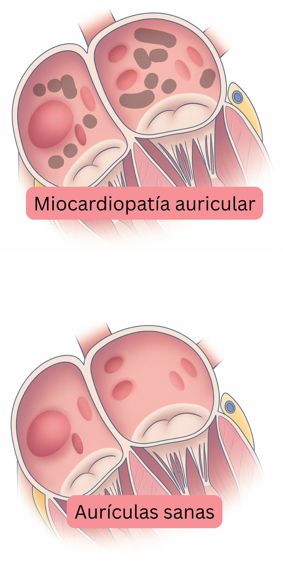Ilustración que compara la miocardiopatía auricular con aurículas sanas, mostrando cambios estructurales y tisulares auriculares relacionados con la fibrilación auricular.