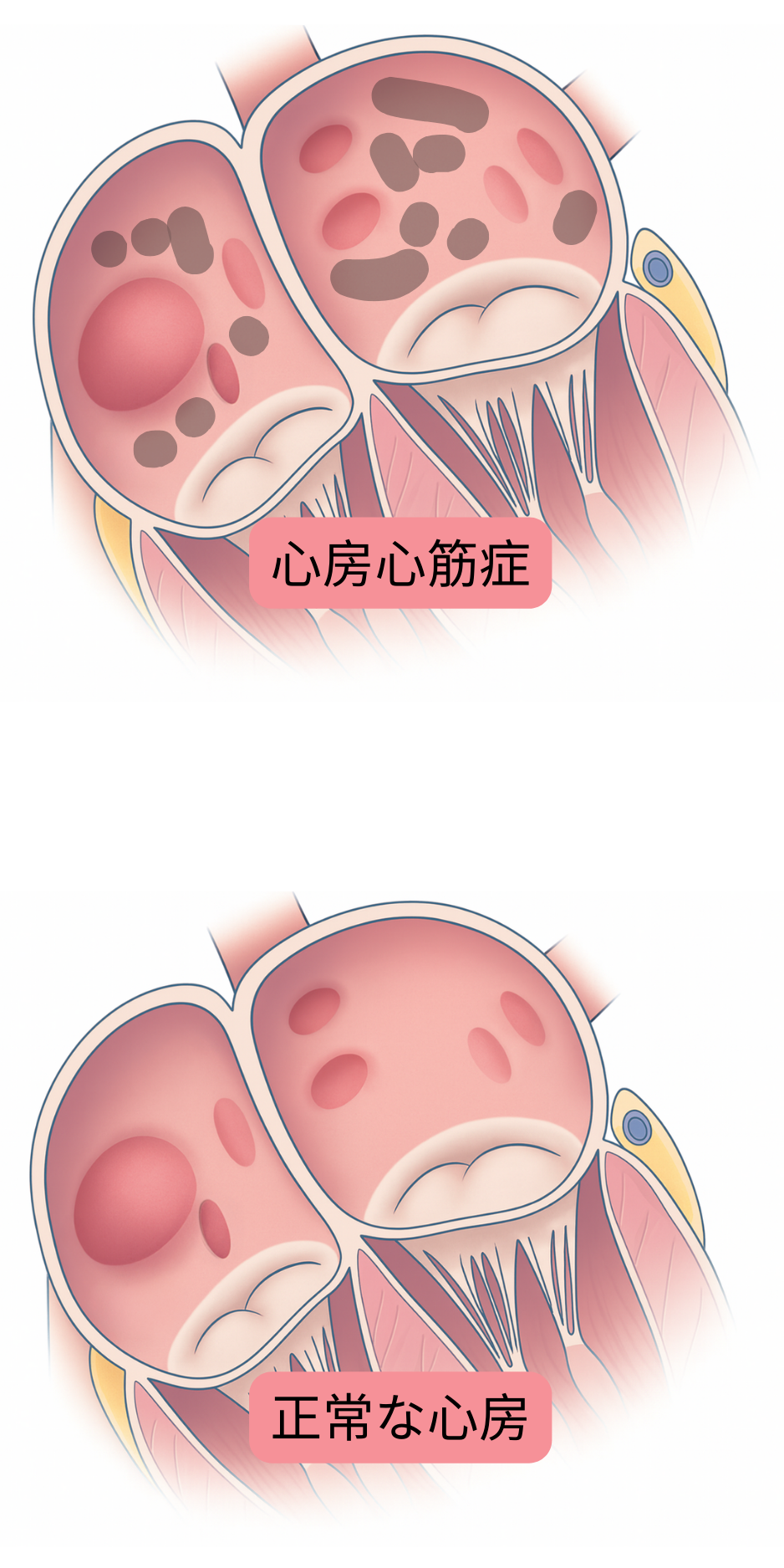 心房心筋症と正常心房を比較し、心房細動に関連する心房の構造的および組織学的リモデリングを示す図。