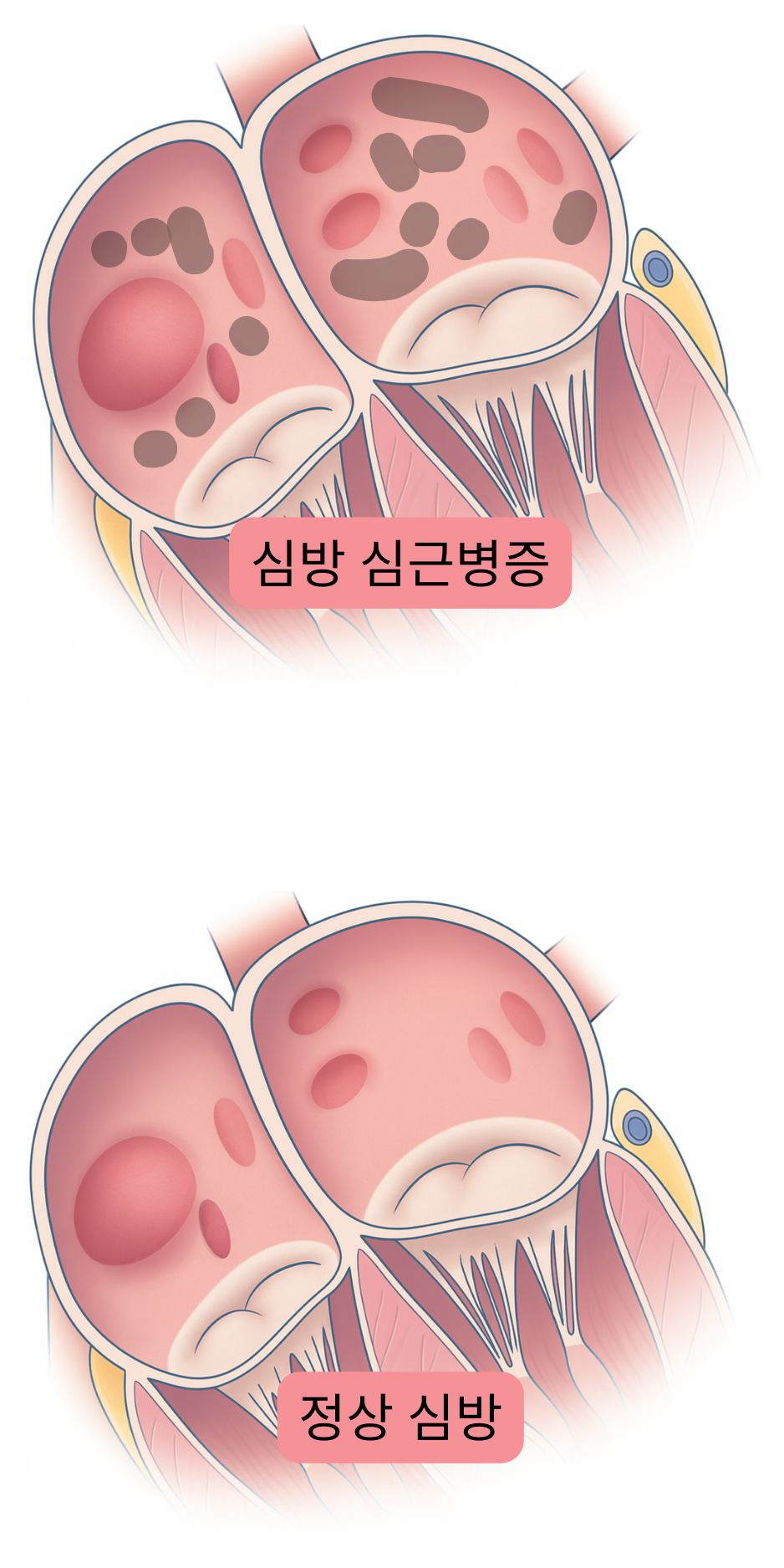 심방 심근병증과 정상 심방을 비교하여 심방세동과 연관된 심방의 구조적 및 조직학적 변화들을 나타낸 그림.