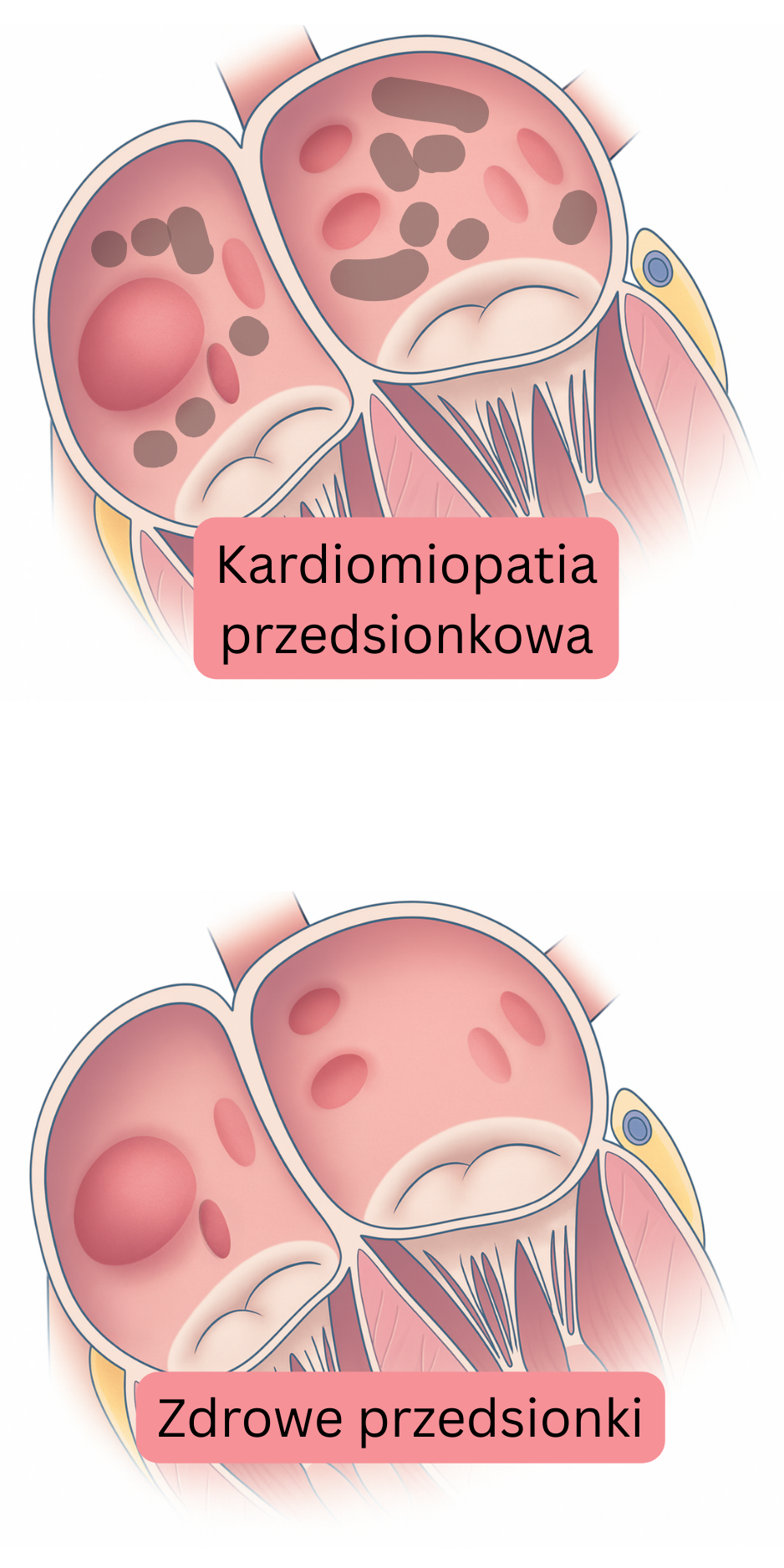 Ilustracja porównująca kardiomiopatię przedsionkową ze zdrowymi przedsionkami, ukazująca zmiany strukturalne i tkankowe związane z migotaniem przedsionków.