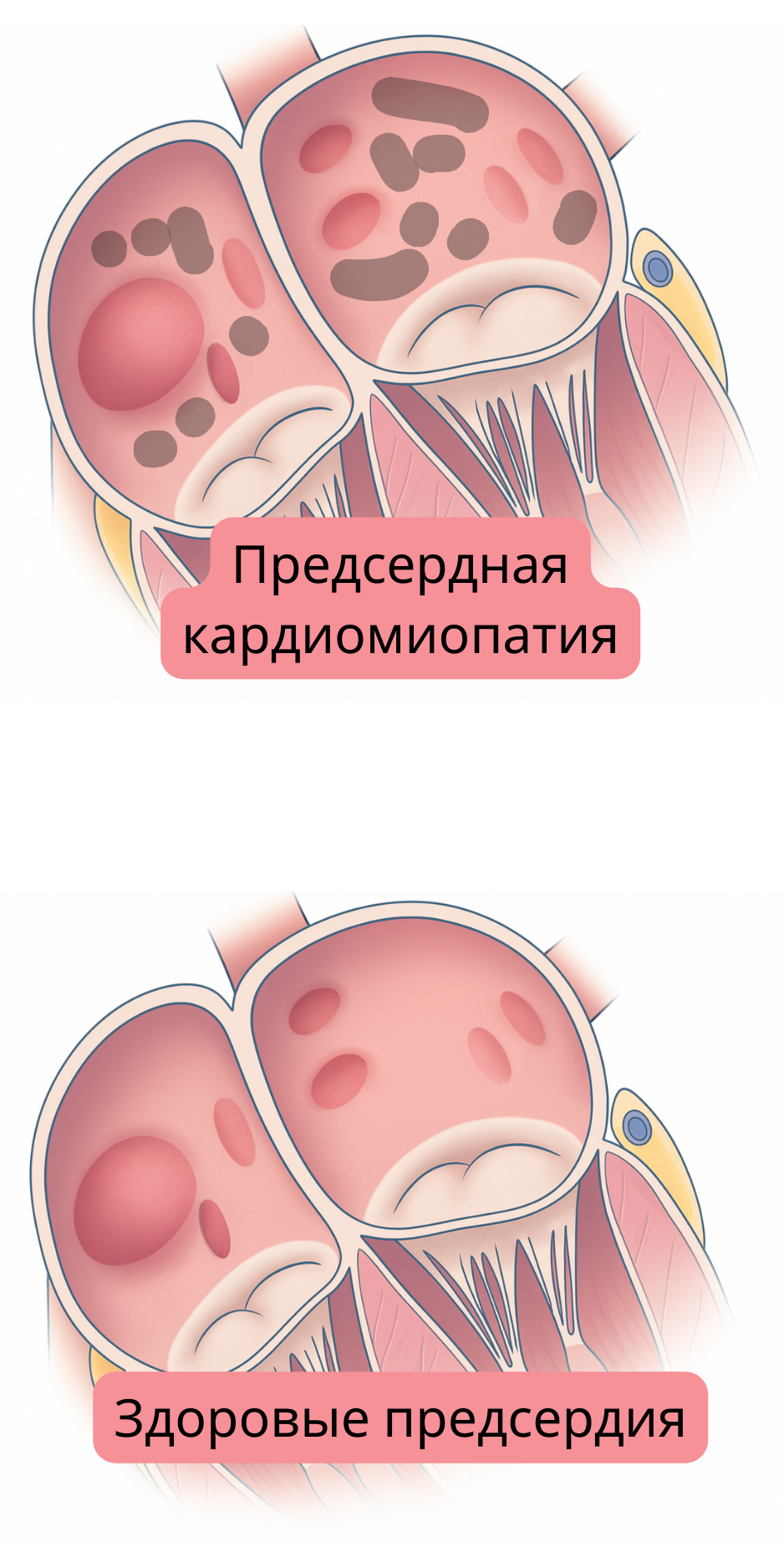 Иллюстрация, сравнивающая предсердную кардиомиопатию со здоровыми предсердиями, с демонстрацией структурных и тканевых изменений, связанных с фибрилляцией предсердий.