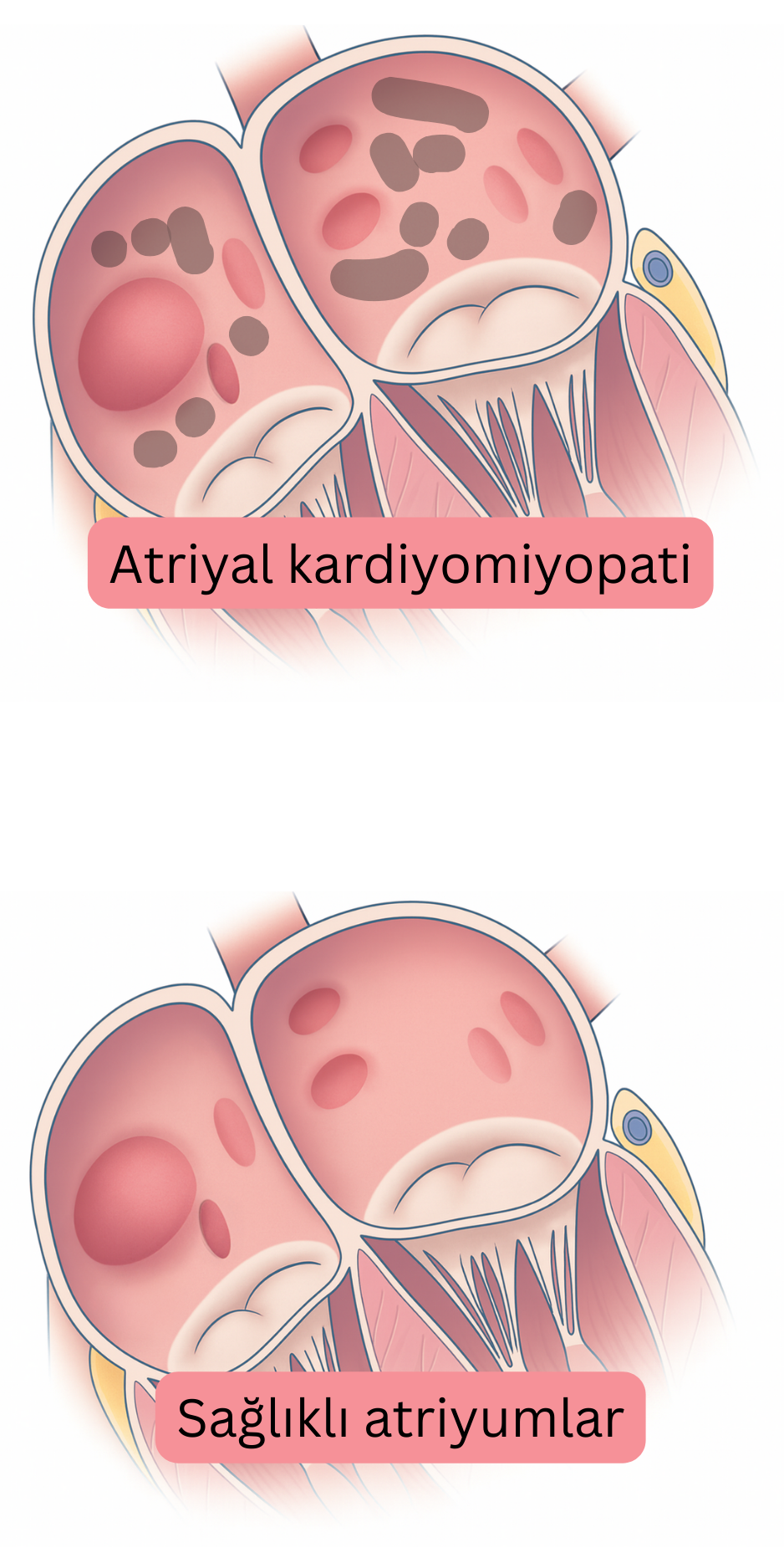 Atriyal kardiyomiyopatiyi sağlıklı atriyumlarla karşılaştıran ve atriyal fibrilasyonla ilişkili atriyal yapısal ve doku değişikliklerini gösteren illüstrasyon.