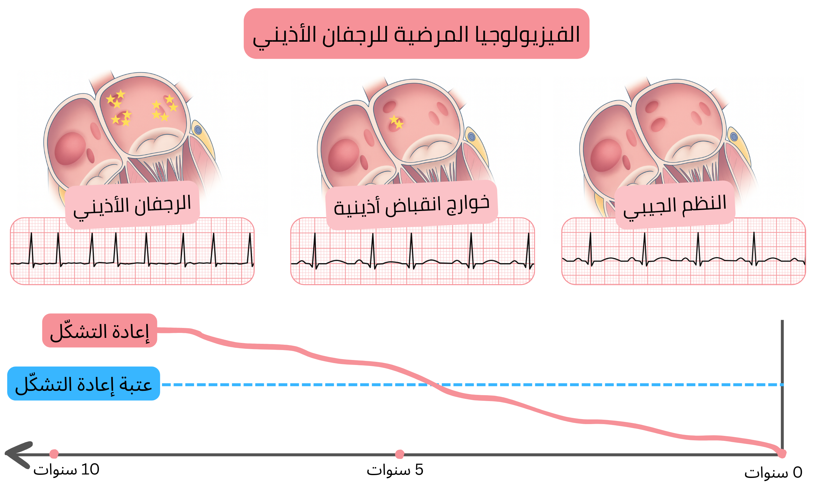 مخطط للفيزيولوجيا المرضية للرجفان الأذيني يوضح الانتقال من النظم الجيبي عبر الخوارج الأذينية إلى الرجفان الأذيني مع إعادة تشكيل أذيني تدريجي بمرور الوقت.