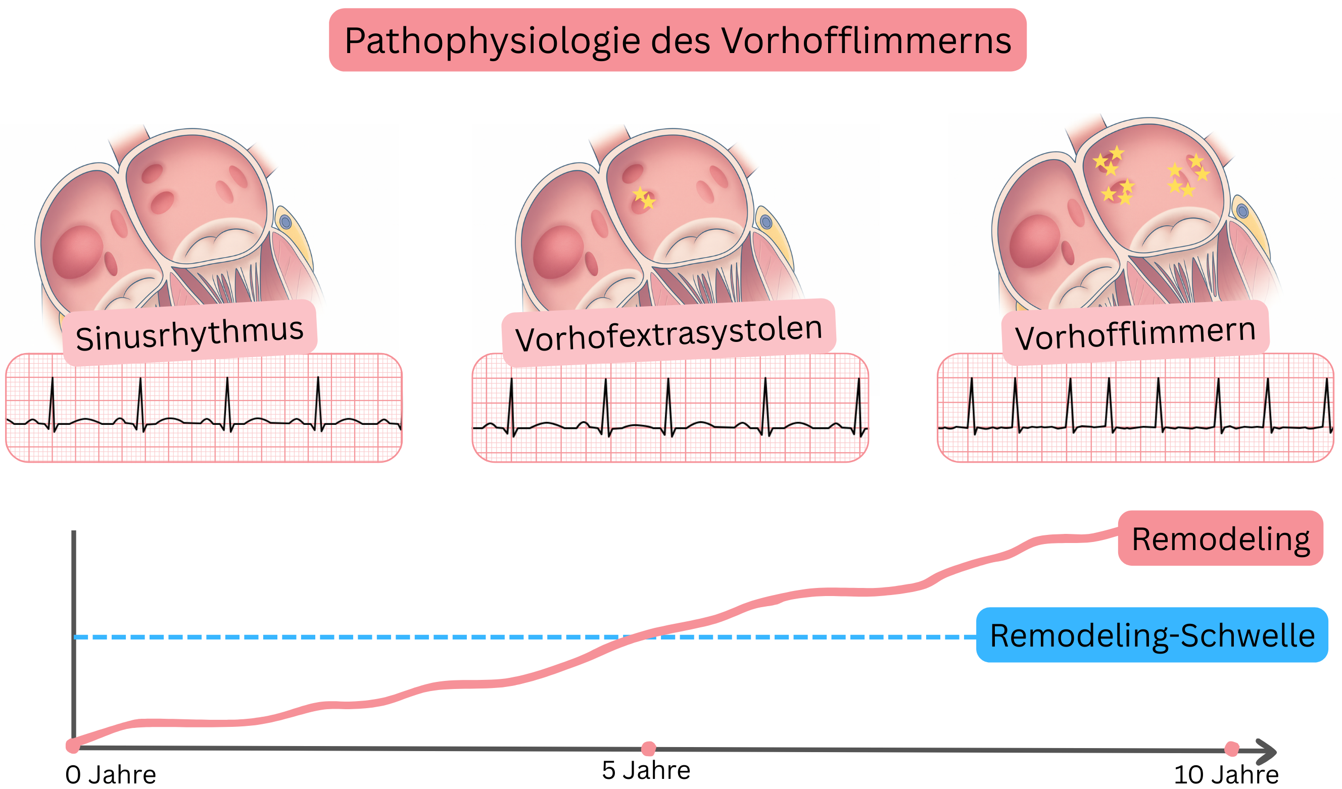 Schema der Pathophysiologie des Vorhofflimmerns mit Darstellung des Übergangs vom Sinusrhythmus über atriale Extrasystolen zum Vorhofflimmern mit fortschreitendem atrialem Remodeling im Zeitverlauf.