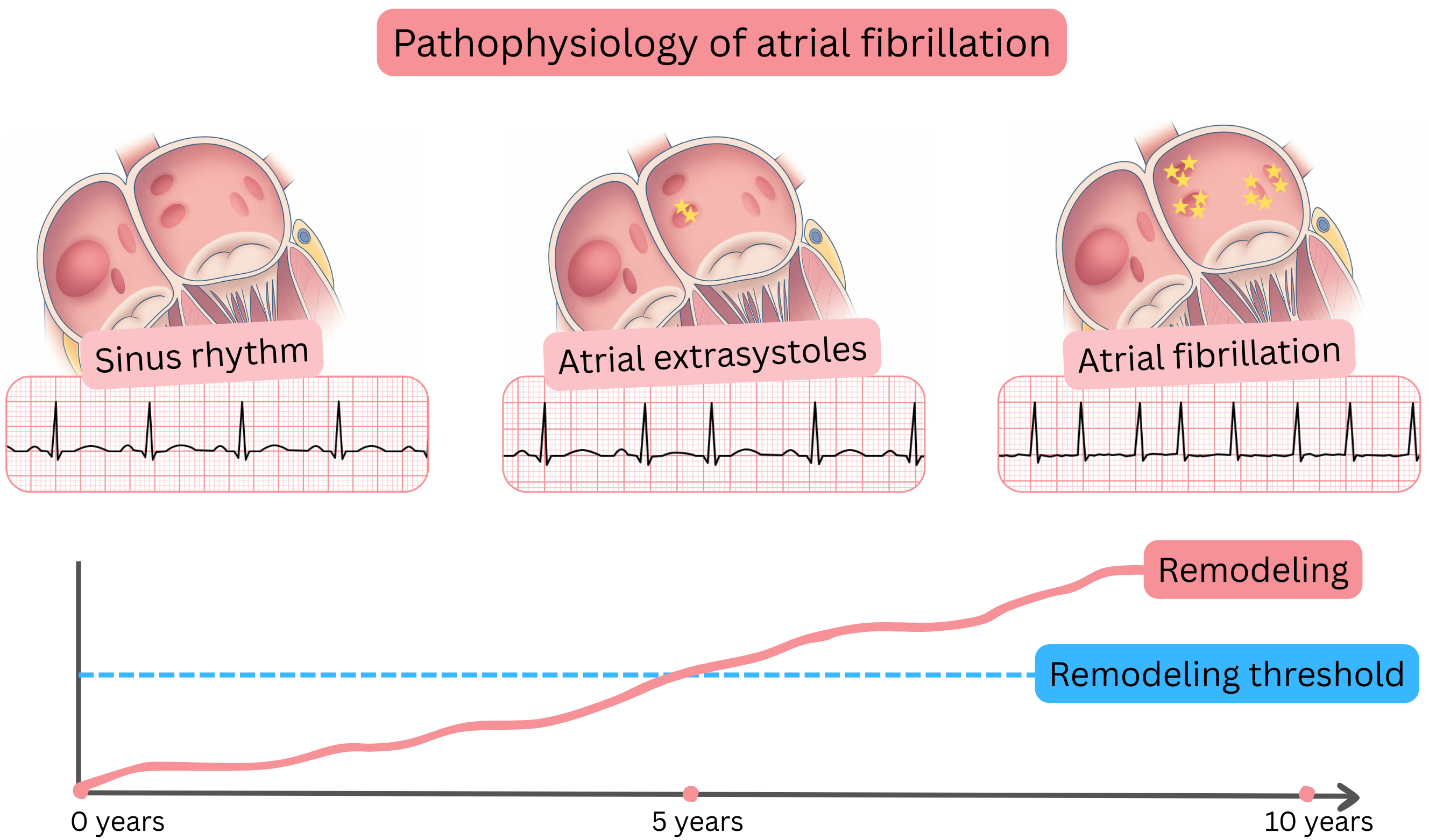 Diagram of atrial fibrillation pathophysiology illustrating progression from sinus rhythm through atrial ectopy to atrial fibrillation with progressive atrial remodeling over time.