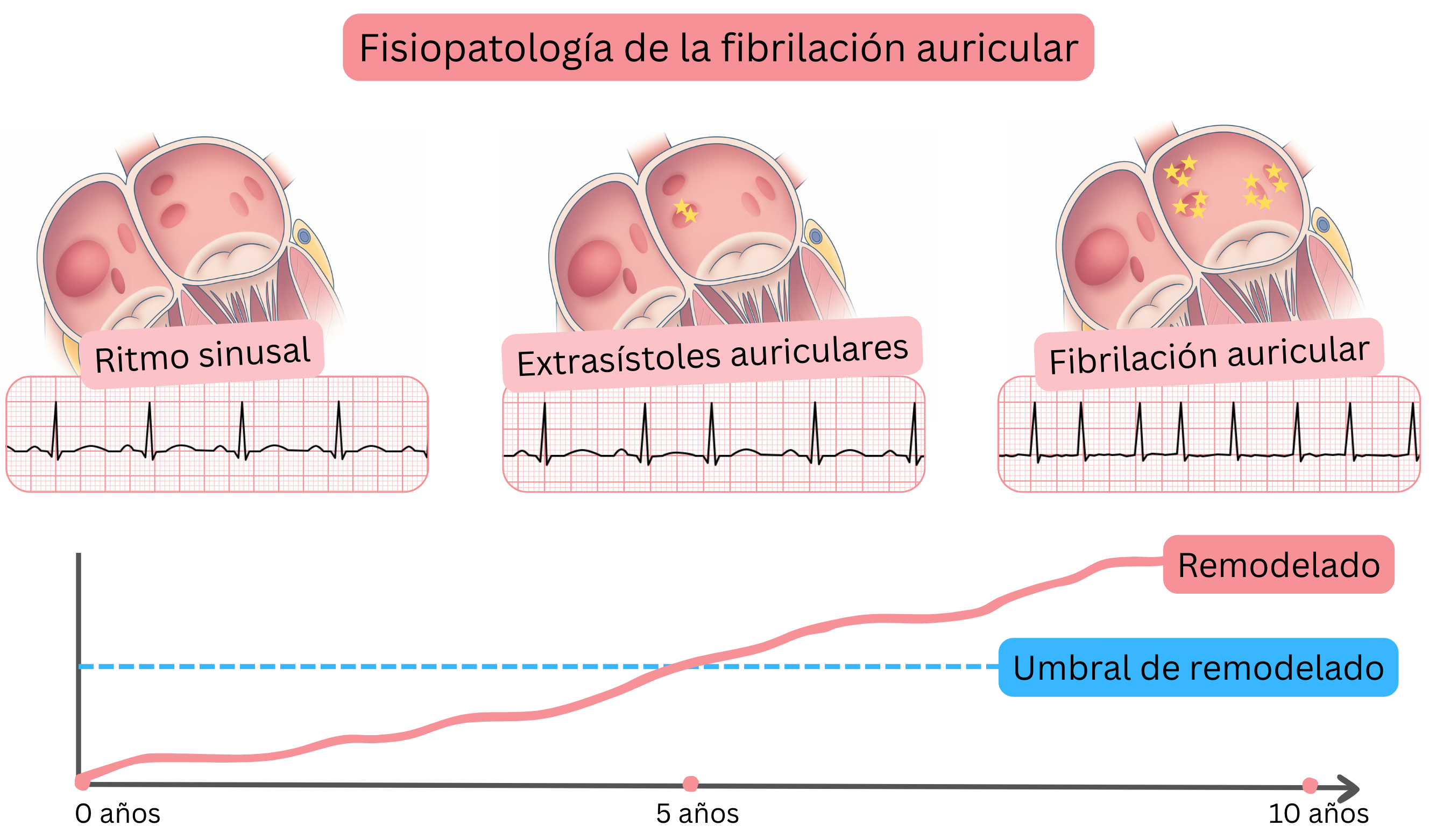 Esquema de la fisiopatología de la fibrilación auricular que muestra la progresión desde el ritmo sinusal, pasando por extrasístoles auriculares, hasta fibrilación auricular con remodelado auricular progresivo en el tiempo.