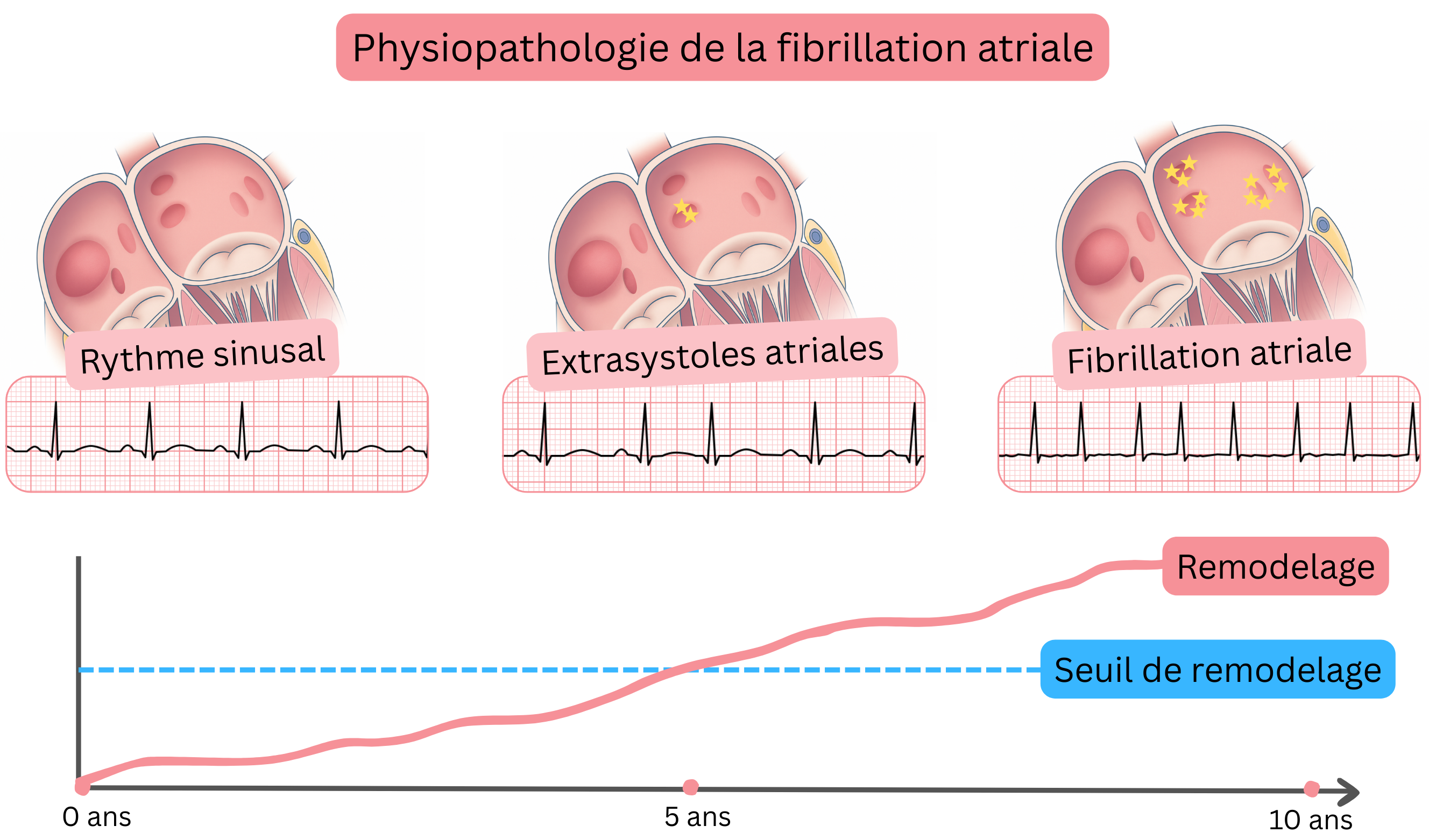 Schéma de la physiopathologie de la fibrillation atriale illustrant la progression du rythme sinusal aux extrasystoles auriculaires puis à la fibrillation atriale avec un remodelage auriculaire progressif au fil du temps.