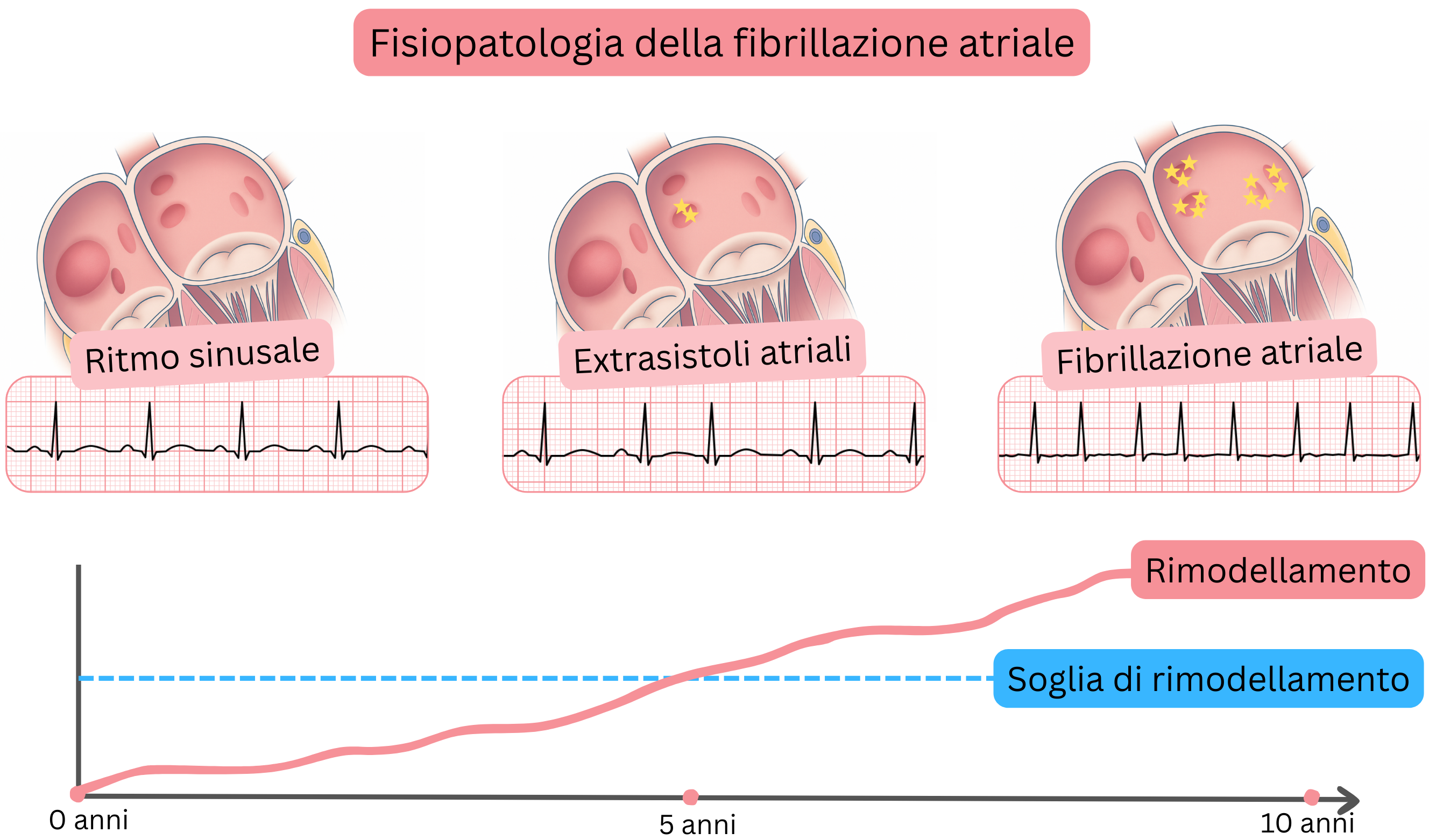 Schema della fisiopatologia della fibrillazione atriale che illustra la progressione dal ritmo sinusale, attraverso extrasistoli atriali, alla fibrillazione atriale con rimodellamento atriale progressivo nel tempo.