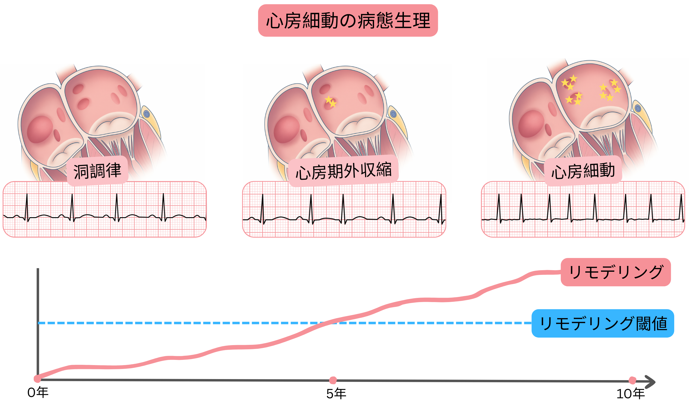 心房細動の病態生理を示す模式図で、洞調律から心房期外収縮を経て、時間とともに進行する心房リモデリングを伴う心房細動への移行を示す。