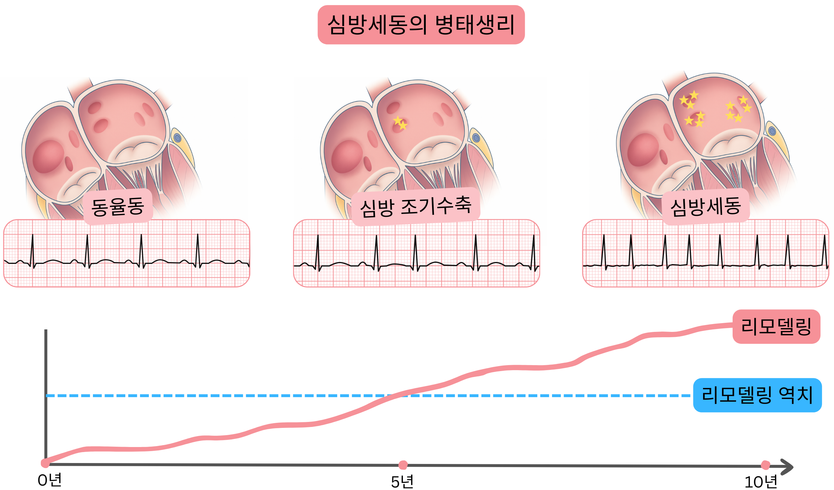 동율동에서 심방 조기수축을 거쳐 시간 경과에 따른 진행성 심방 재형성과 함께 심방세동으로 이행하는 과정을 보여주는 심방세동 병태생리 도식.