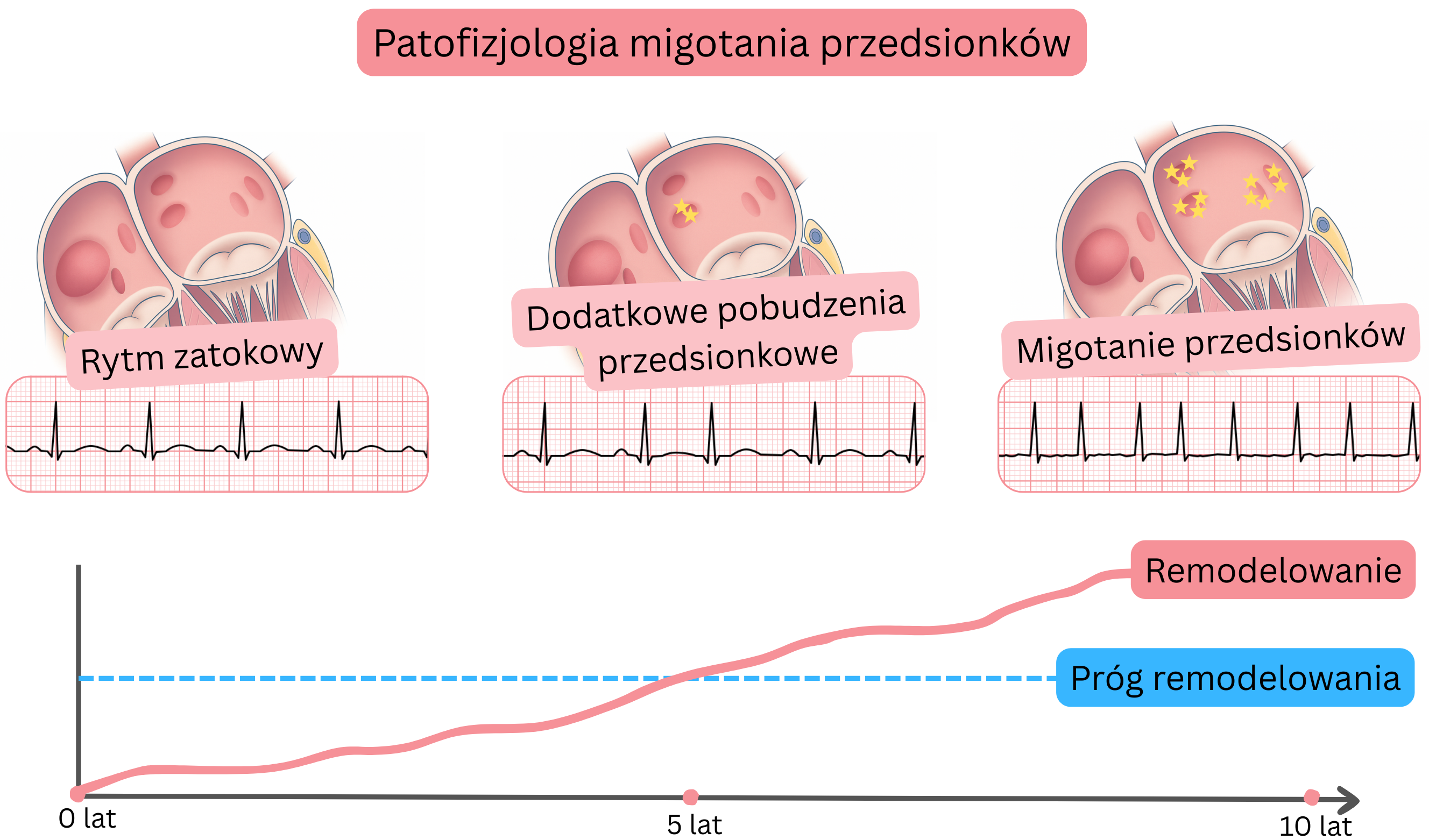 Schemat patofizjologii migotania przedsionków przedstawiający przejście od rytmu zatokowego przez ekstrasystolie przedsionkowe do migotania przedsionków z postępującą remodelacją przedsionków w czasie.
