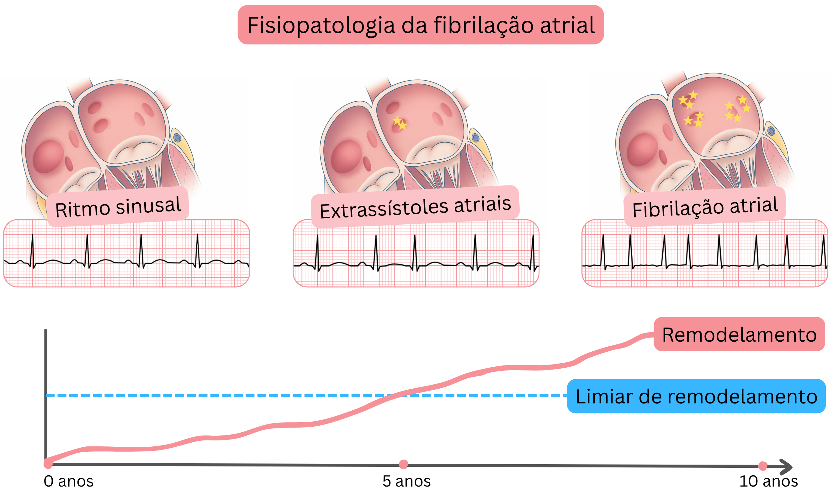 Esquema da fisiopatologia da fibrilação atrial ilustrando a progressão do ritmo sinusal, passando por extrassístoles atriais, até fibrilação atrial com remodelação atrial progressiva ao longo do tempo.