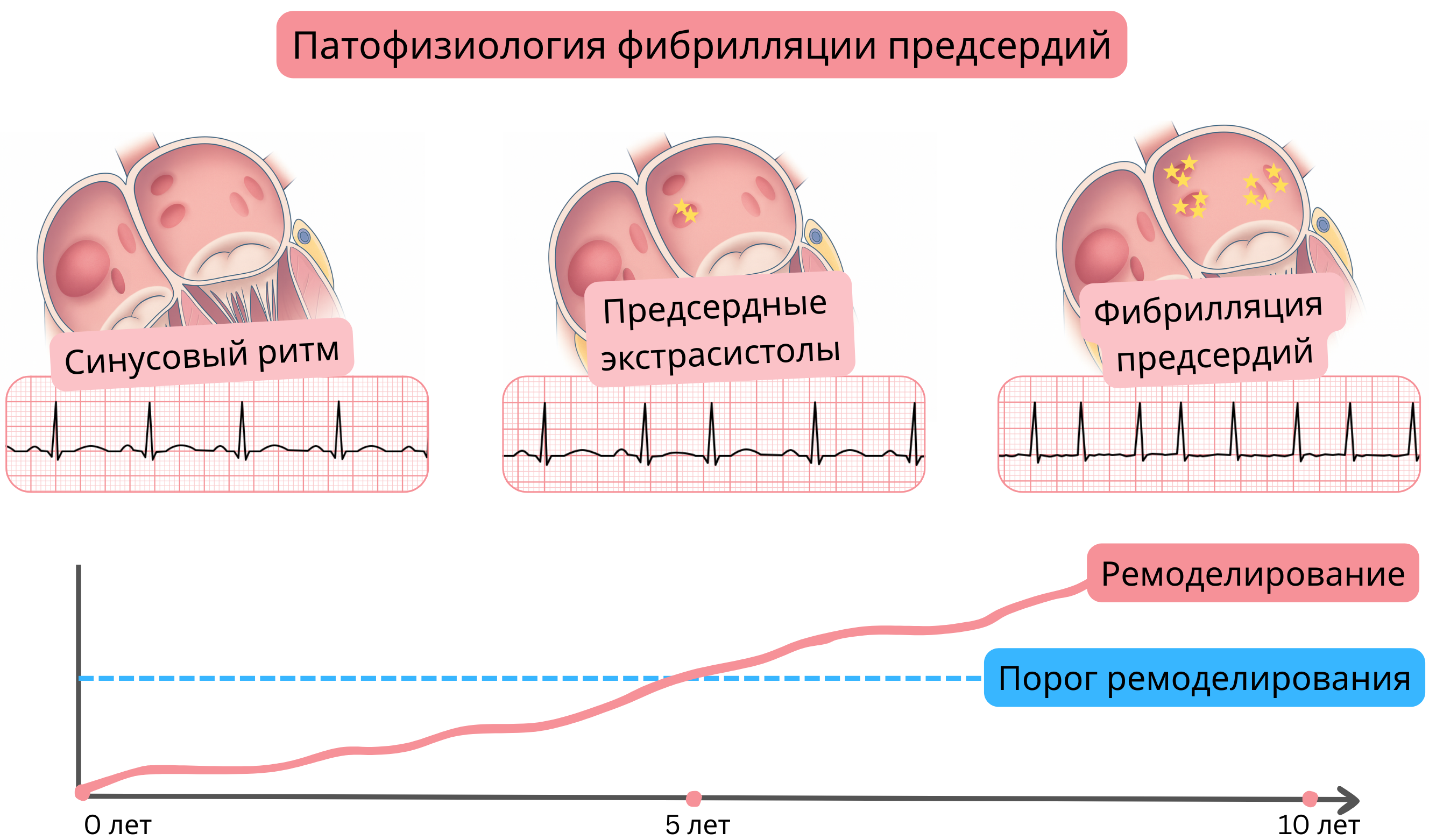 Схема патофизиологии фибрилляции предсердий, демонстрирующая переход от синусового ритма через предсердные экстрасистолы к фибрилляции предсердий с прогрессирующим предсердным ремоделированием со временем.