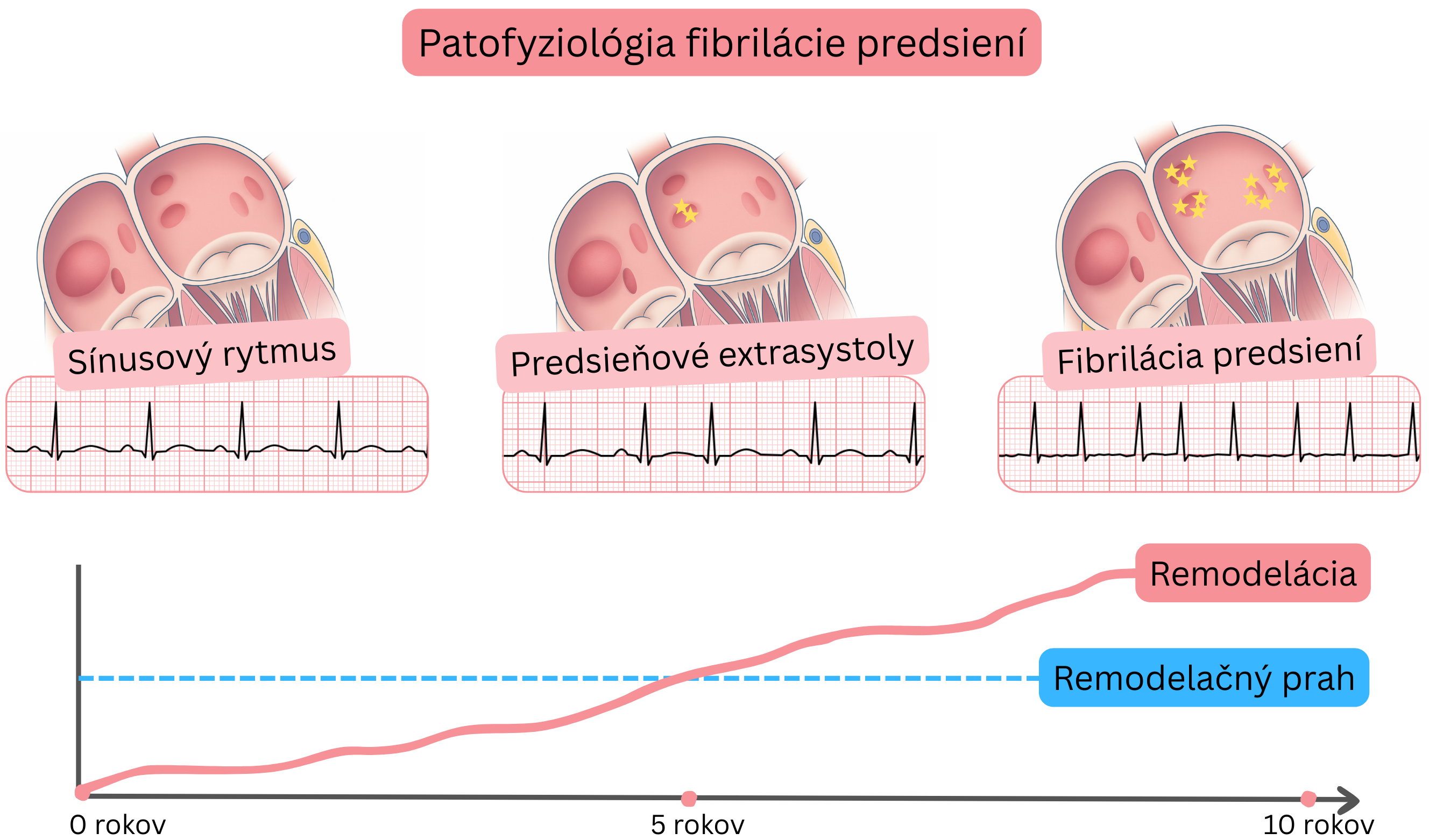 Schéma patofyziológie fibrilácie predsiení znázorňujúca prechod od sínusového rytmu cez predsieňové extrasystoly k fibrilácii predsiení s progresívnou predsieňovou remodeláciou v čase.