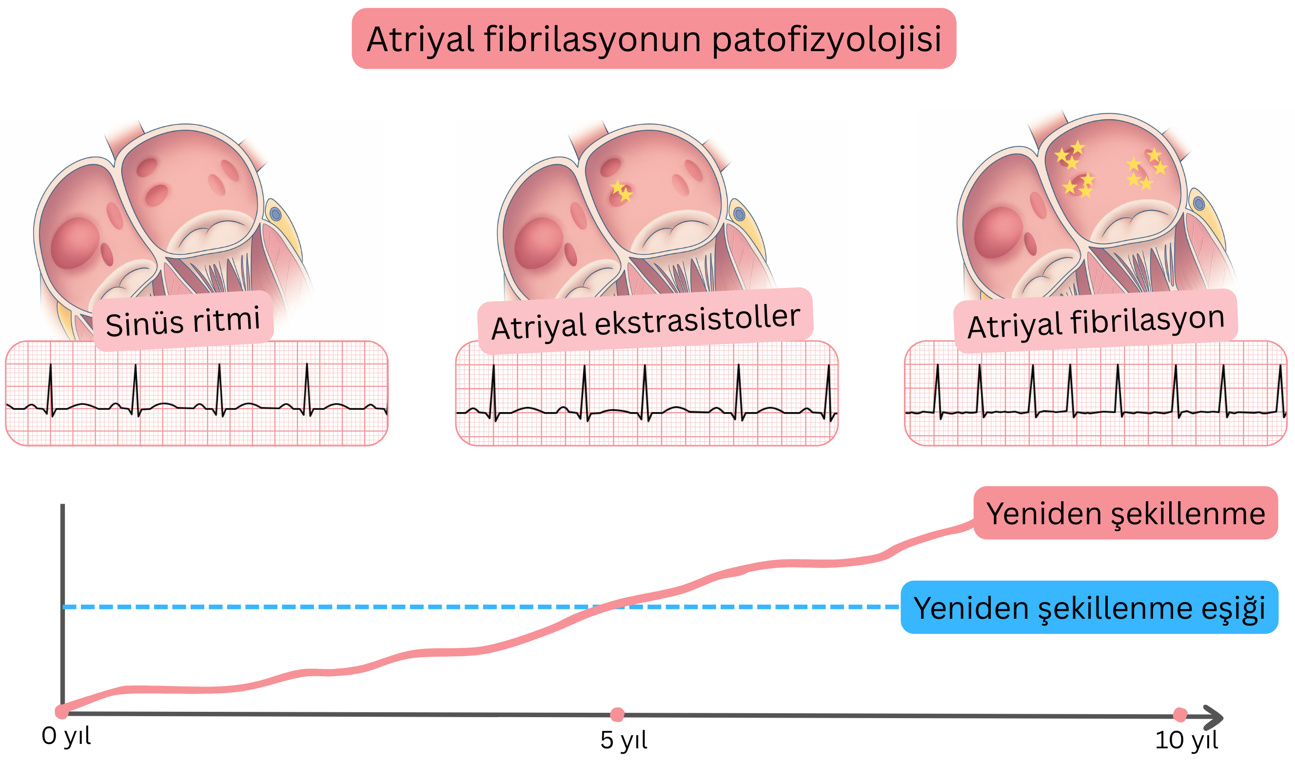 Atriyal fibrilasyonun patofizyolojisini gösteren şema; sinüs ritminden atriyal ekstrasistoller üzerinden zamana bağlı progresif atriyal yeniden yapılanma ile atriyal fibrilasyona geçişi göstermektedir.