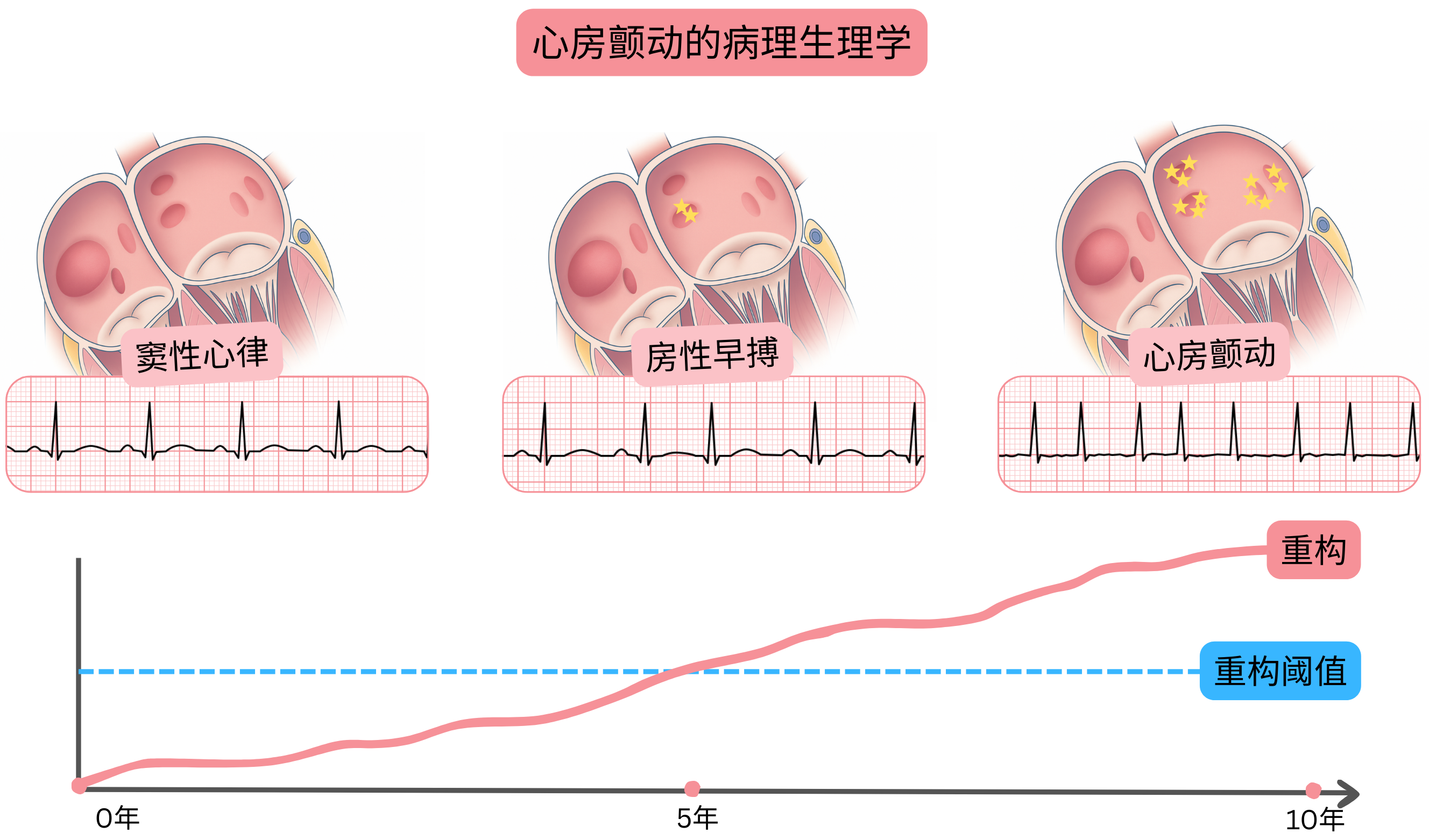 心房颤动病理生理示意图，展示从窦性心律经房性早搏发展为心房颤动，并伴随随时间进展的心房重构。