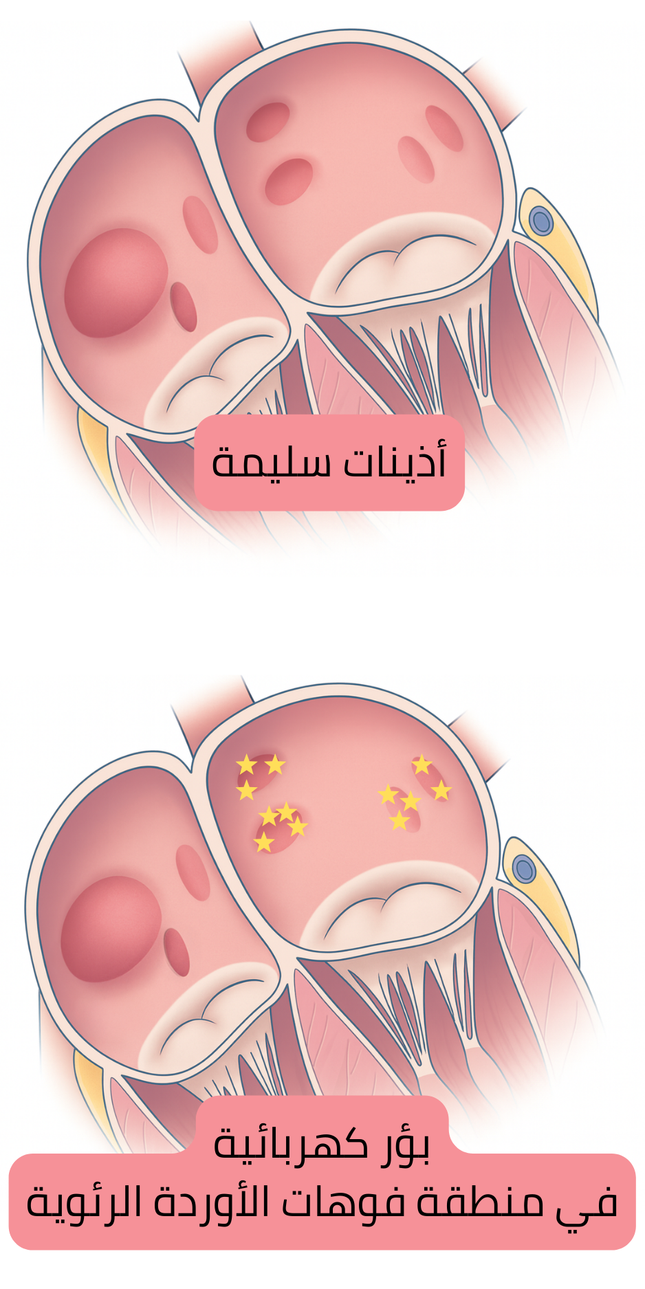 رسم توضيحي يقارن الأذينين السليمين ببؤر كهربائية في مناطق فوهات الأوردة الرئوية تعمل كمحفزات للرجفان الأذيني.