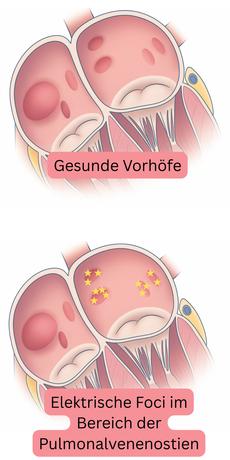 Illustration zum Vergleich gesunder Vorhöfe mit elektrischen Foci im Bereich der Ostien der Lungenvenen als Auslöser von Vorhofflimmern.