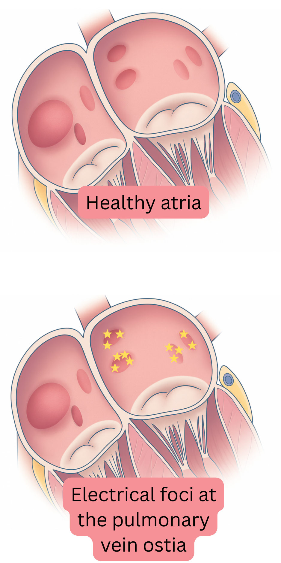 Illustration comparing healthy atria with electrical foci at the pulmonary vein ostia acting as triggers of atrial fibrillation.