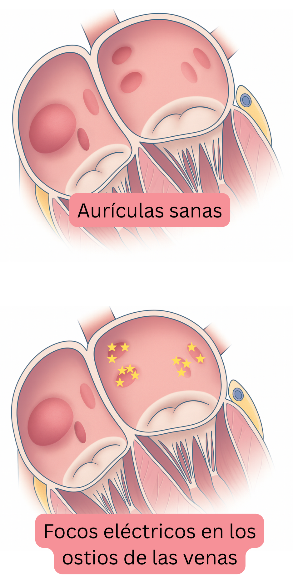 Ilustración que compara aurículas sanas con focos eléctricos en los ostios de las venas pulmonares como desencadenantes de la fibrilación auricular.