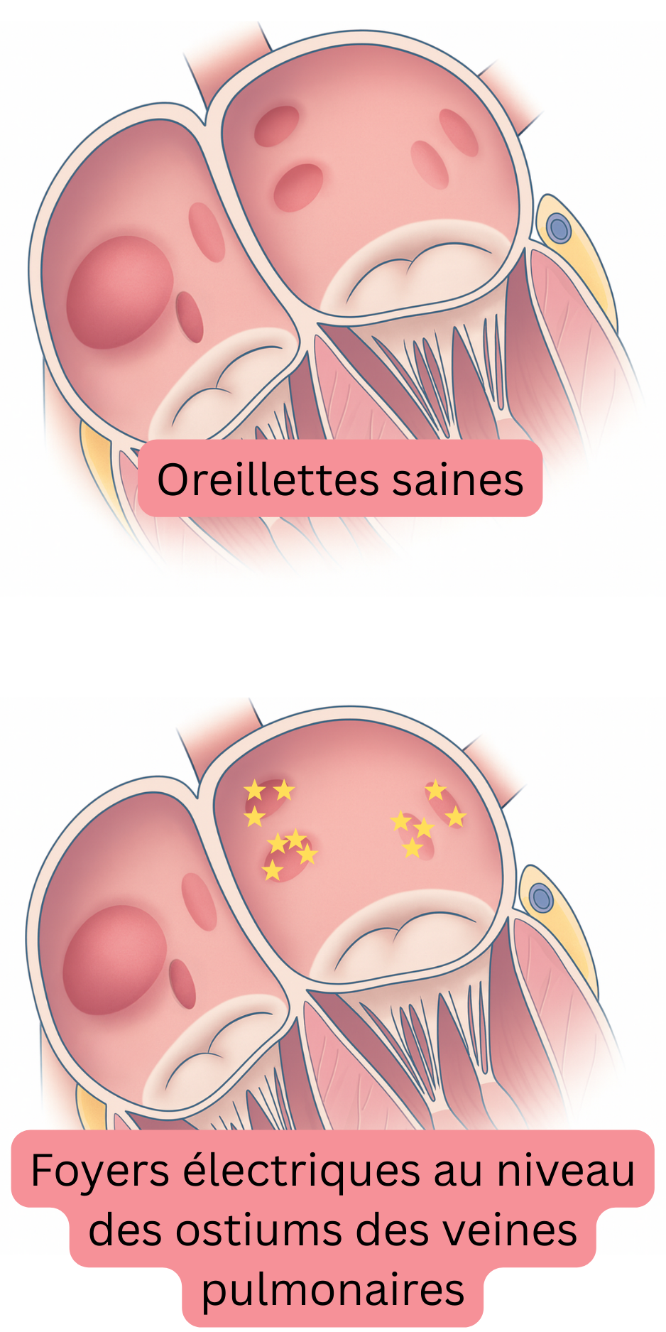 Illustration comparant des oreillettes saines à des foyers électriques situés aux ostiums des veines pulmonaires, agissant comme déclencheurs de la fibrillation atriale.