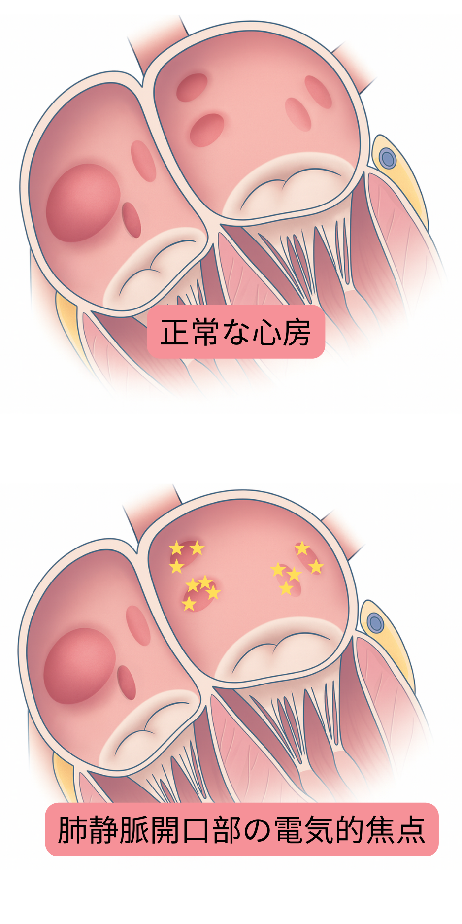 健常心房と、心房細動のトリガーとなる肺静脈開口部の電気的焦点を比較した模式図。
