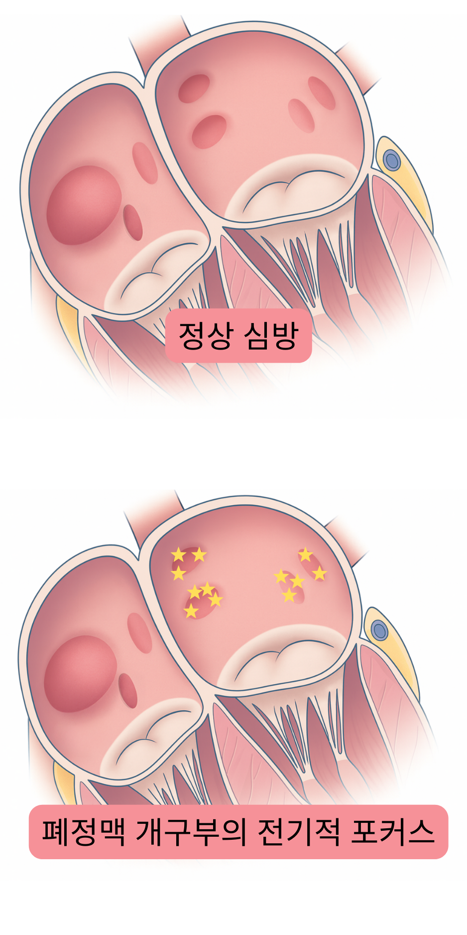 정상 심방과 심방세동의 유발 인자로 작용하는 폐정맥 개구부의 전기적 초점을 비교한 그림.