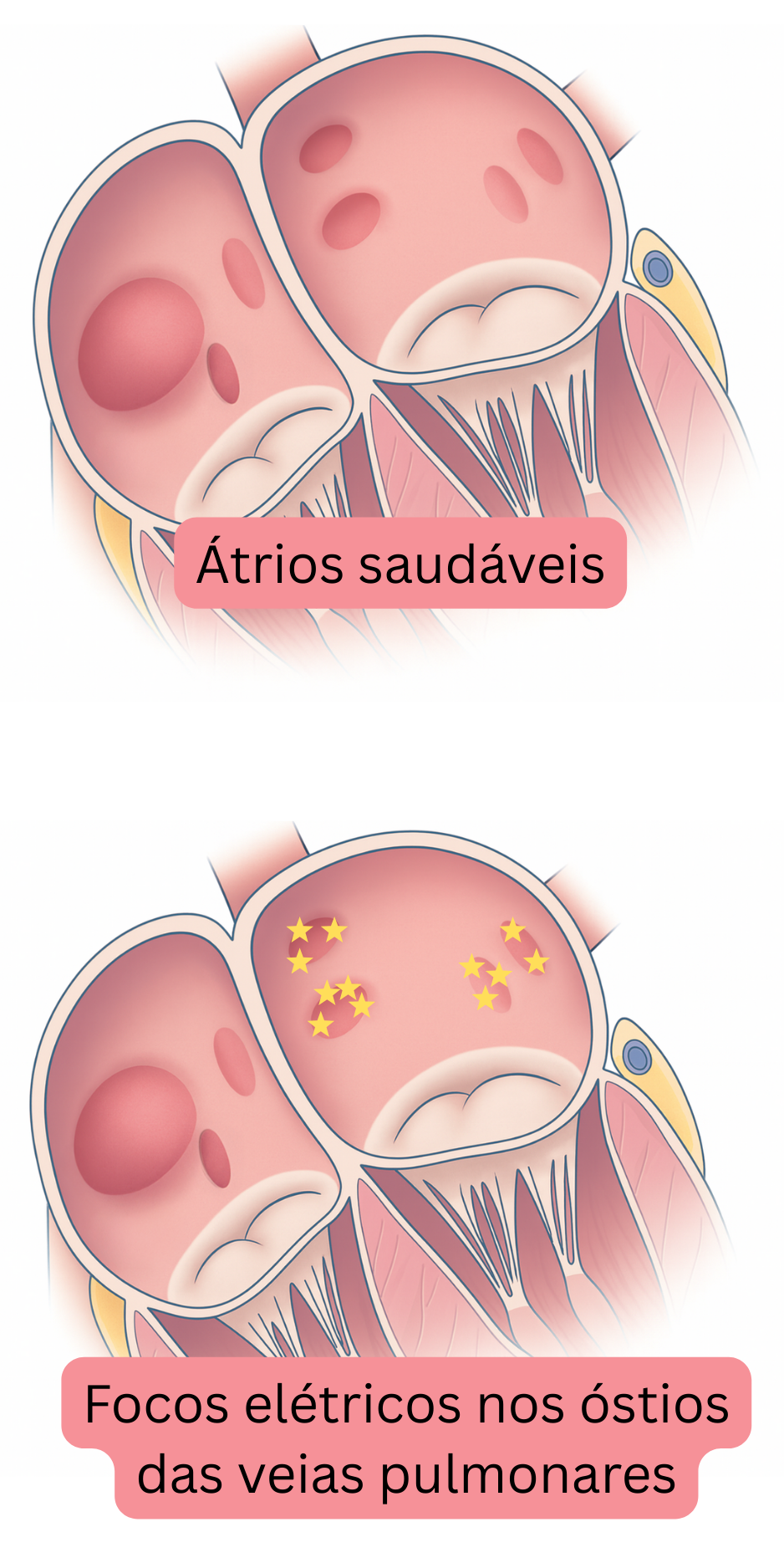 Ilustração comparando átrios saudáveis com focos elétricos nos óstios das veias pulmonares como gatilhos da fibrilação atrial.