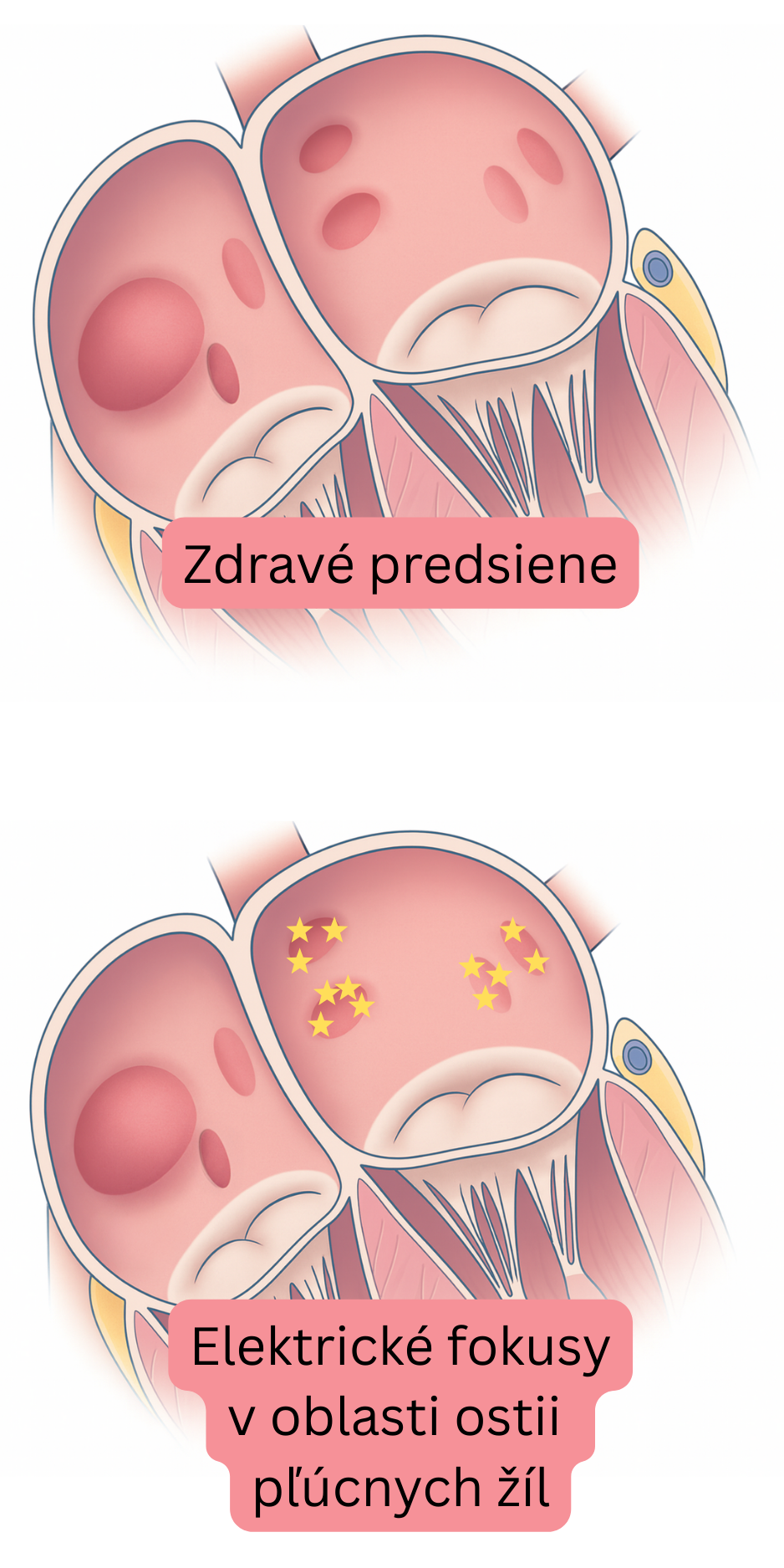 Ilustrácia porovnávajúca zdravé predsiene s elektrickými fokusmi v oblasti ostií pľúcnych žíl ako spúšťačmi fibrilácie predsiení.