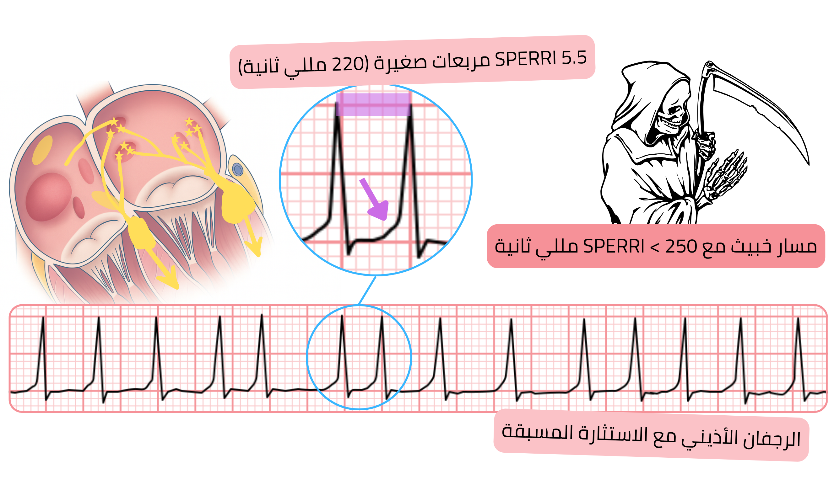 مخطط للرجفان الأذيني مع الاستثارة المسبقة مع SPERRI قصير أقل من 250 مللي ثانية، مما يشير إلى مسار إضافي خبيث واستجابات بطينية سريعة على تخطيط القلب.