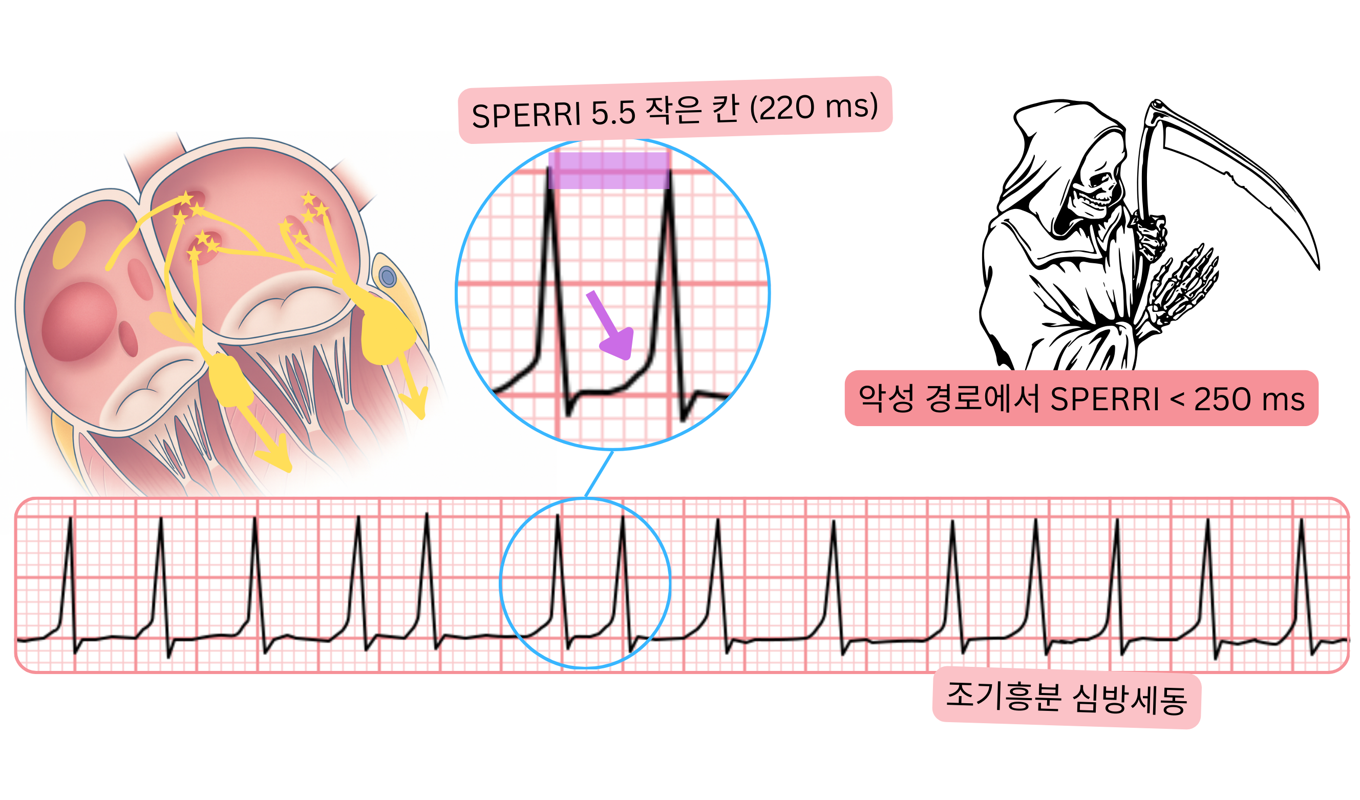 SPERRI가 250ms 미만으로 짧은 전흥분 심방세동 도식으로, 악성 부전도로와 심전도에서의 빠른 심실 반응을 나타낸다.