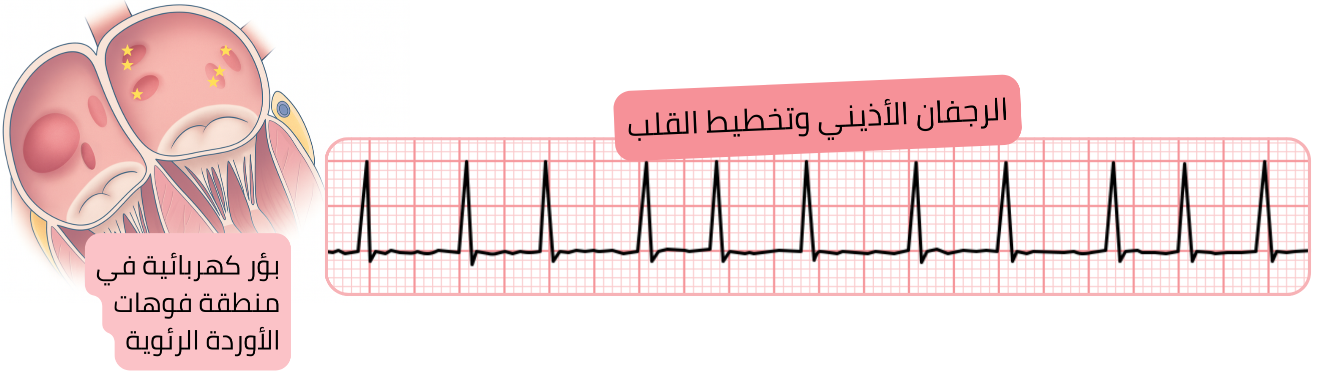رسم توضيحي للرجفان الأذيني على تخطيط القلب مع إبراز البؤر الكهربائية في فوهات الأوردة الرئوية كمحفزات لاضطراب النظم.