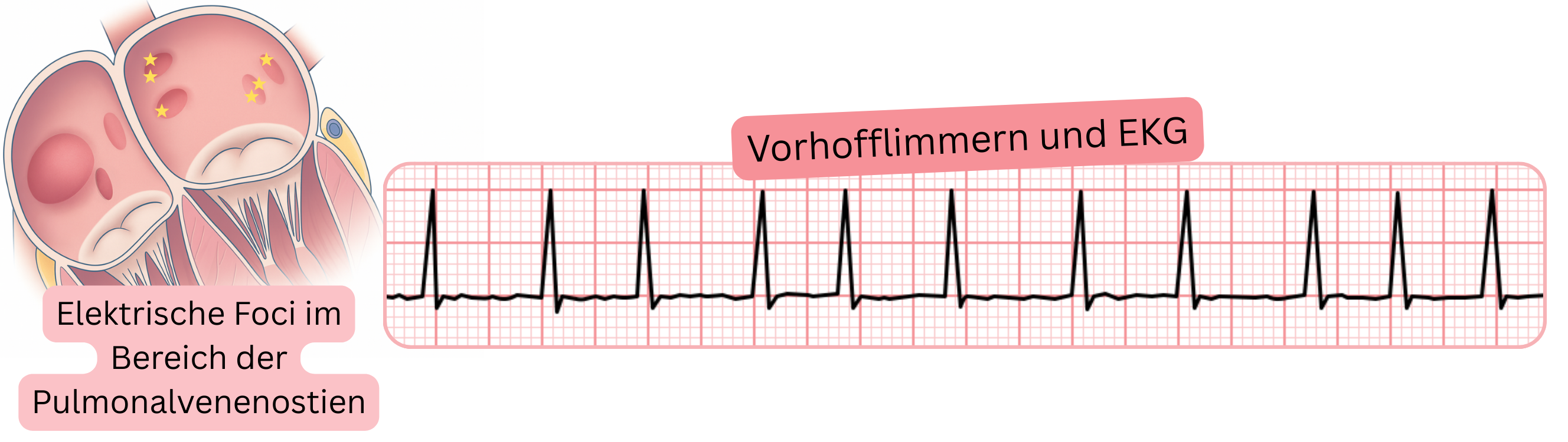 Illustration des Vorhofflimmerns im EKG mit Darstellung elektrischer Foci im Bereich der Ostien der Lungenvenen als Auslöser der Arrhythmie.