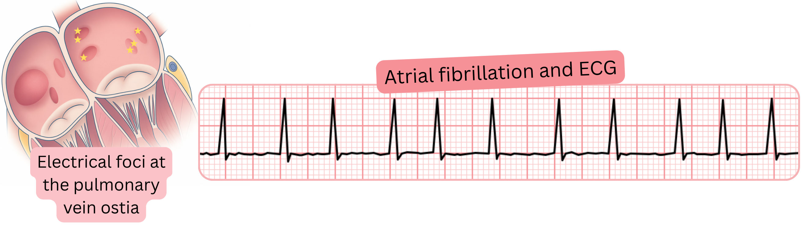 Illustration of atrial fibrillation on ECG highlighting electrical foci at the pulmonary vein ostia as triggers of the arrhythmia.