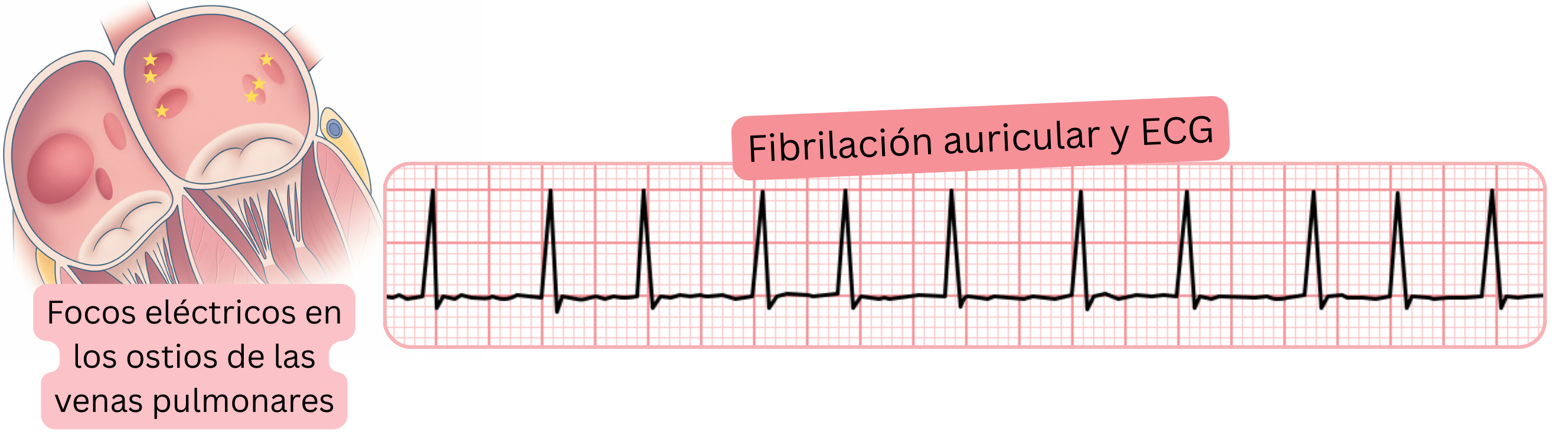 Ilustración de la fibrilación auricular en el ECG que muestra focos eléctricos en los ostios de las venas pulmonares como desencadenantes de la arritmia.